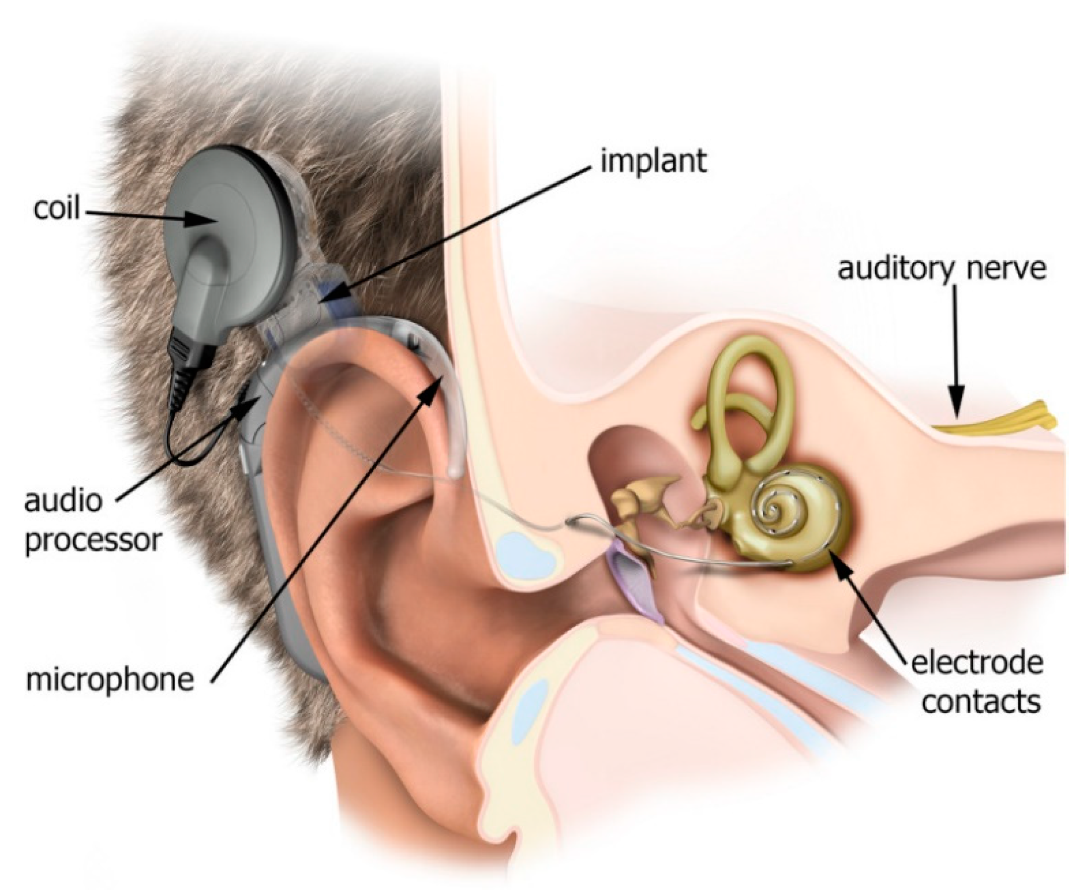 Electronics | Free Full-Text | Machine Learning and Cochlear Implantation:  Predicting the Post-Operative Electrode Impedances