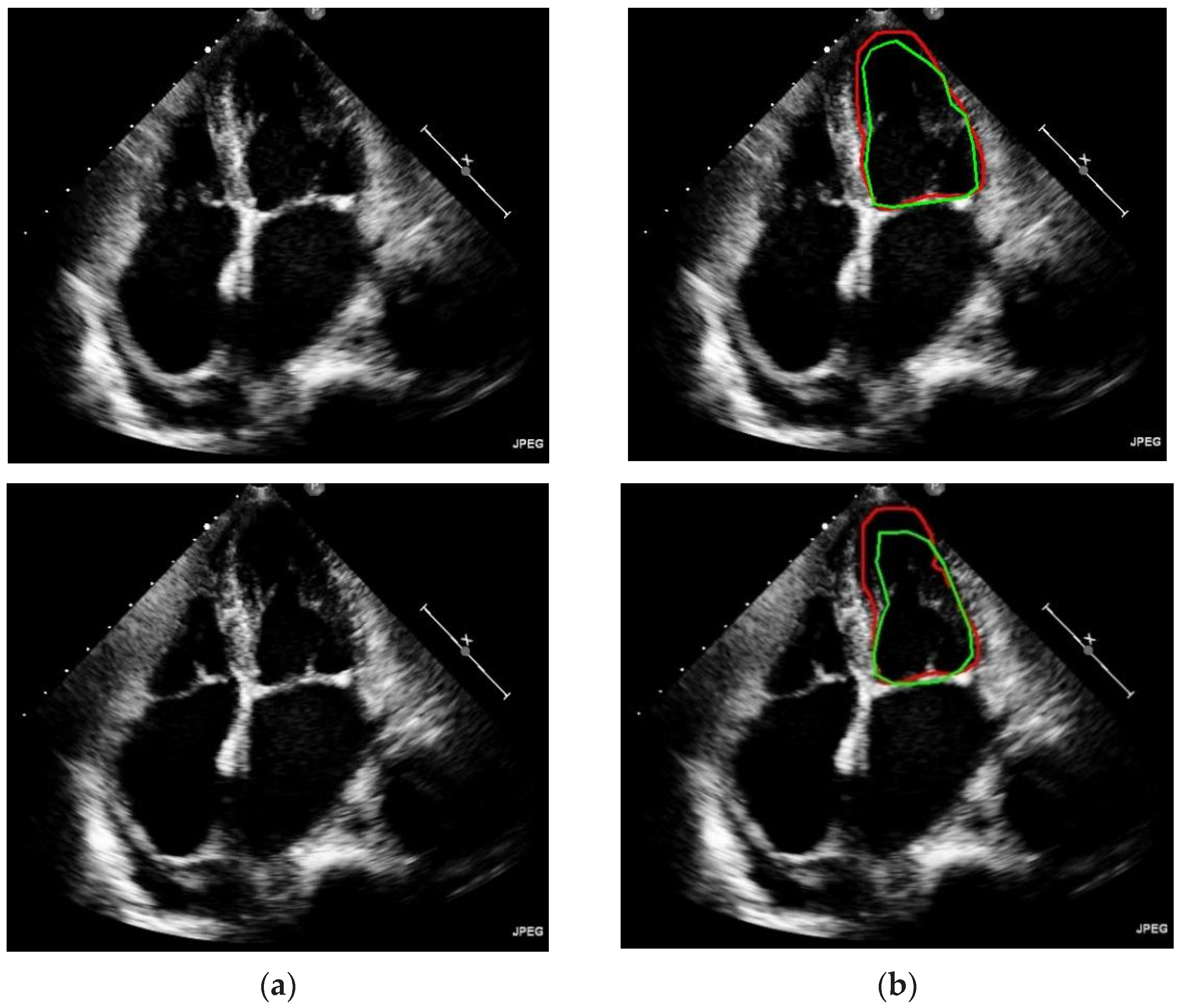 Electronics Free Full Text Automated Left Ventricle Segmentation In Echocardiography Using 5546