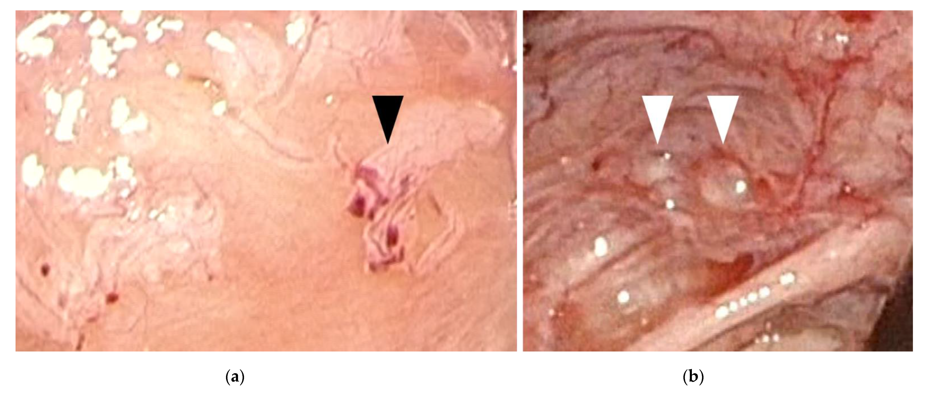 An 11-year-old girl with biopsy-proven juvenile (virginal) breast