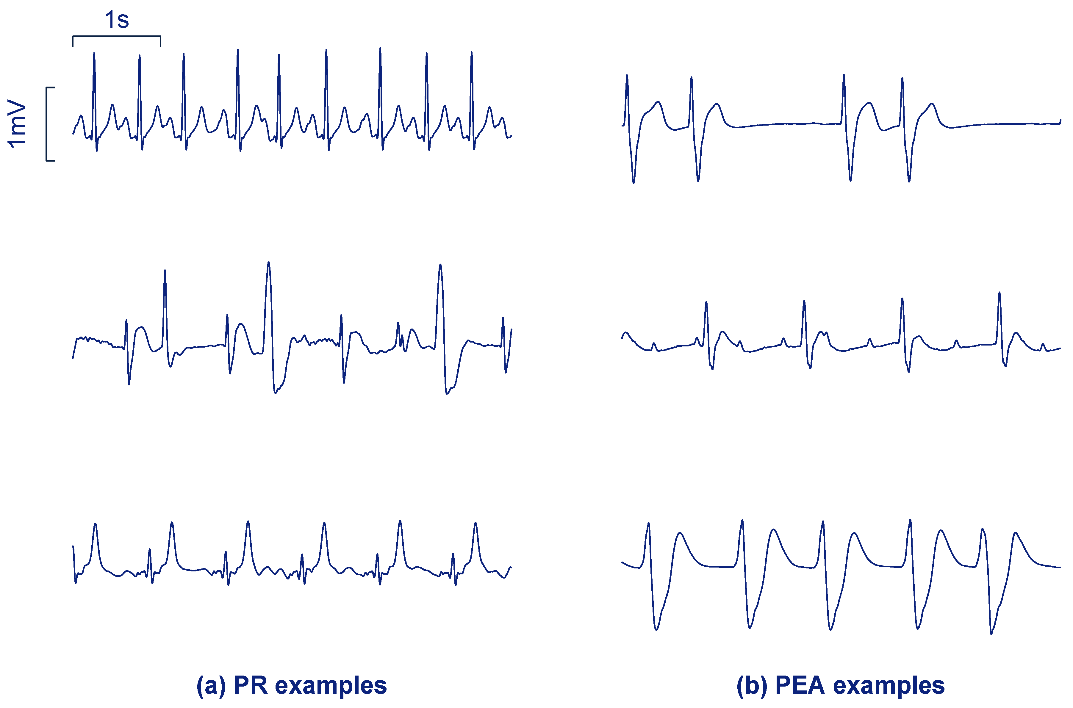 Pulseless Electrical Activity Ekg Pulseless Electrical Activity Ekg
