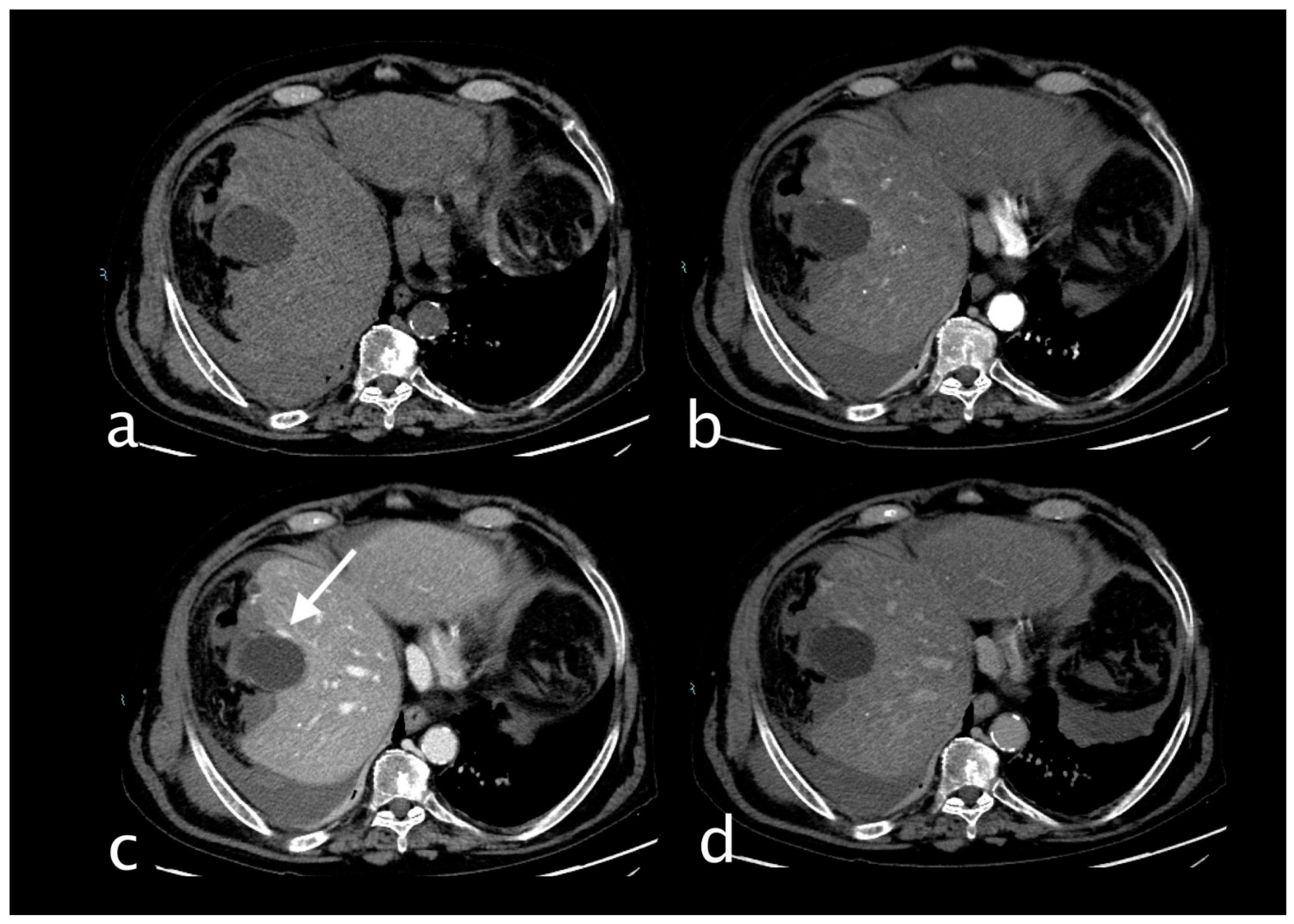 Cystic Artery Bleeding: Imaging Insights and Systematic Review of ...