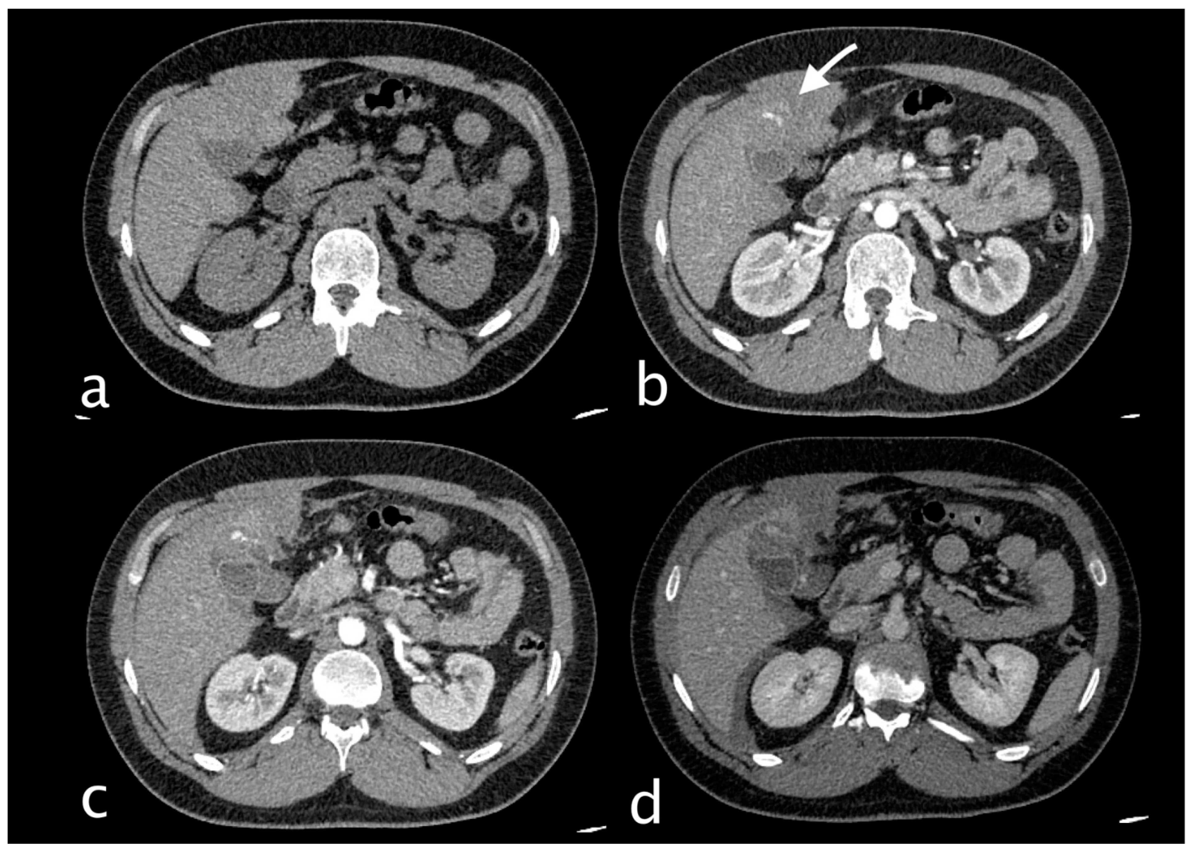 Cystic Artery Bleeding: Imaging Insights and Systematic Review of ...