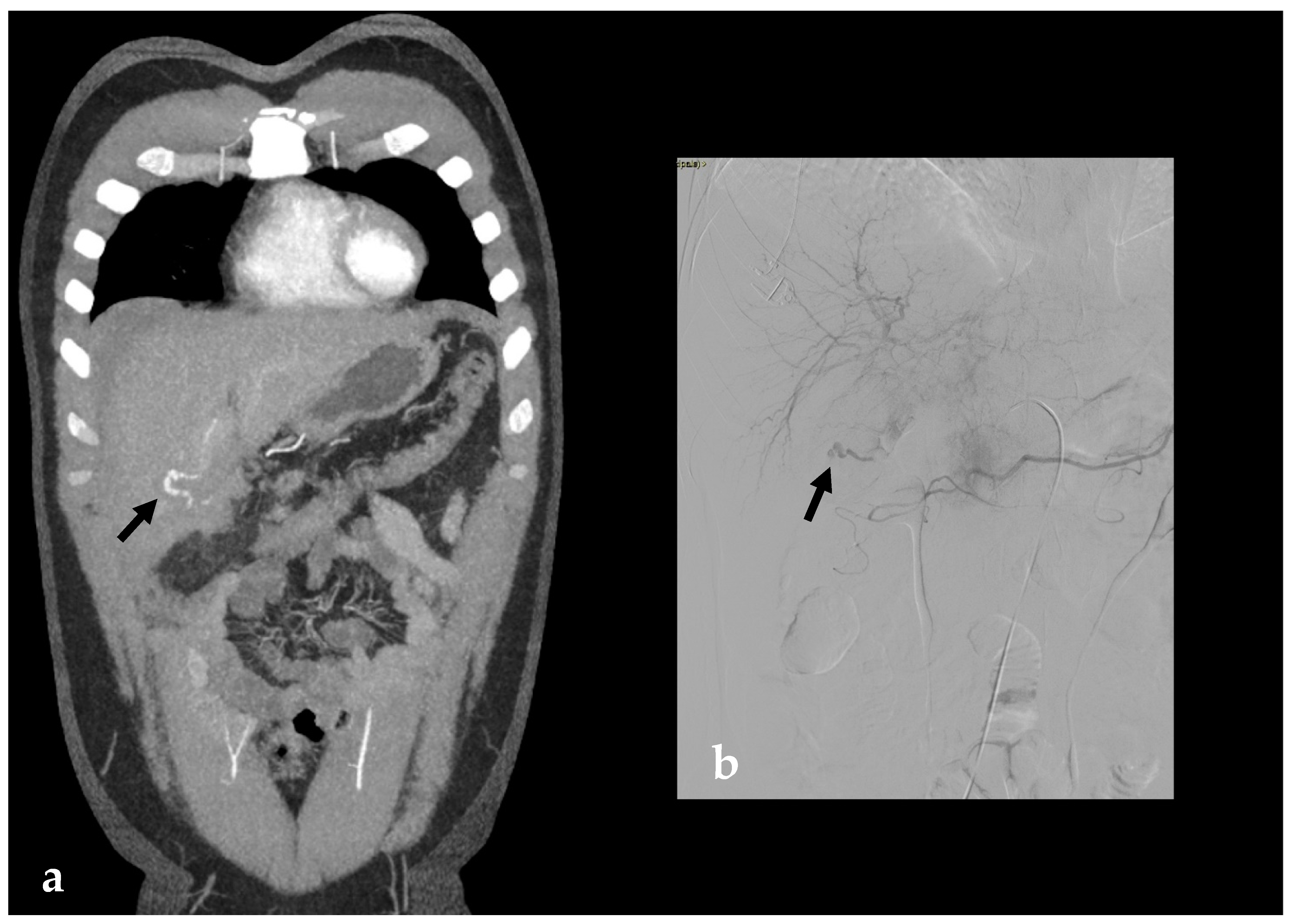 Cystic Artery Bleeding: Imaging Insights and Systematic Review of ...