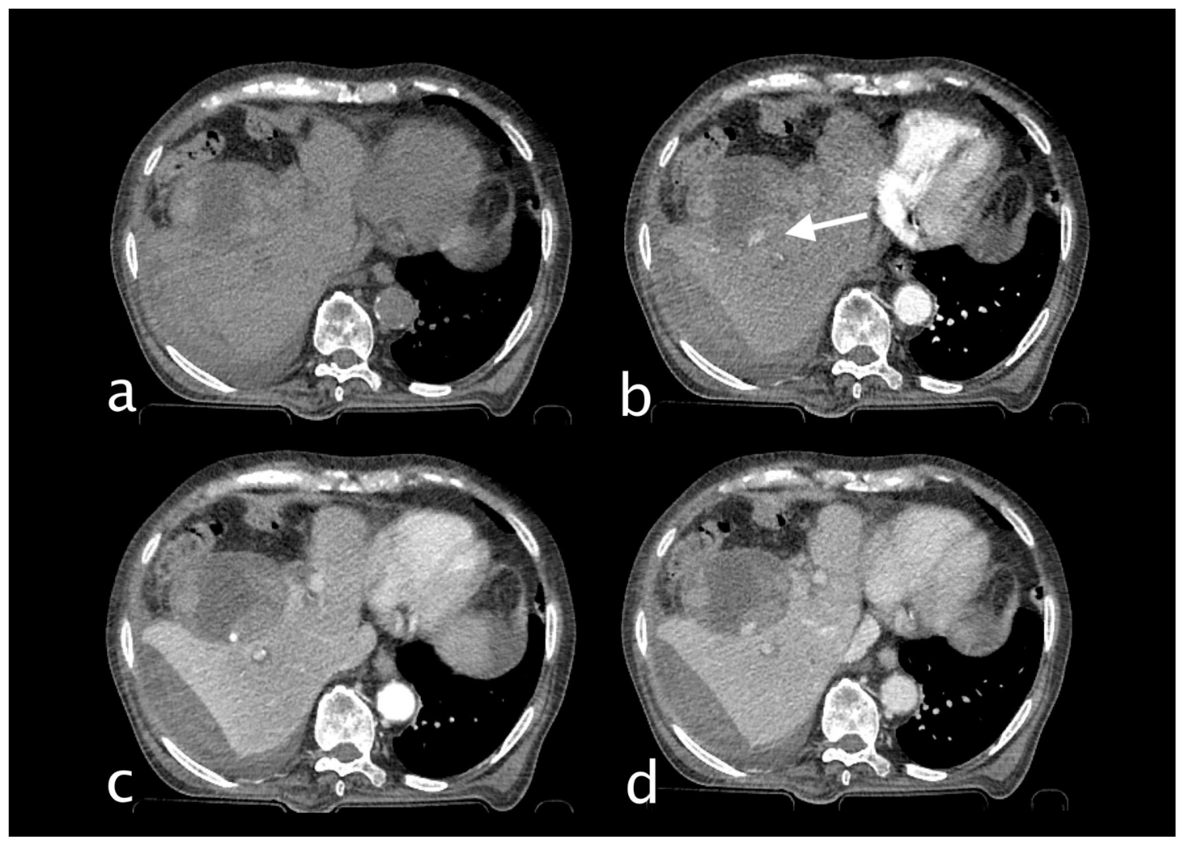 Cystic Artery Bleeding: Imaging Insights and Systematic Review of ...