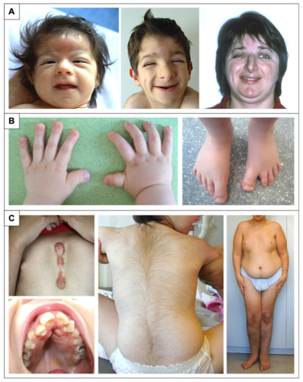 Rubinstein-Taybi Syndrome Images — DermNet