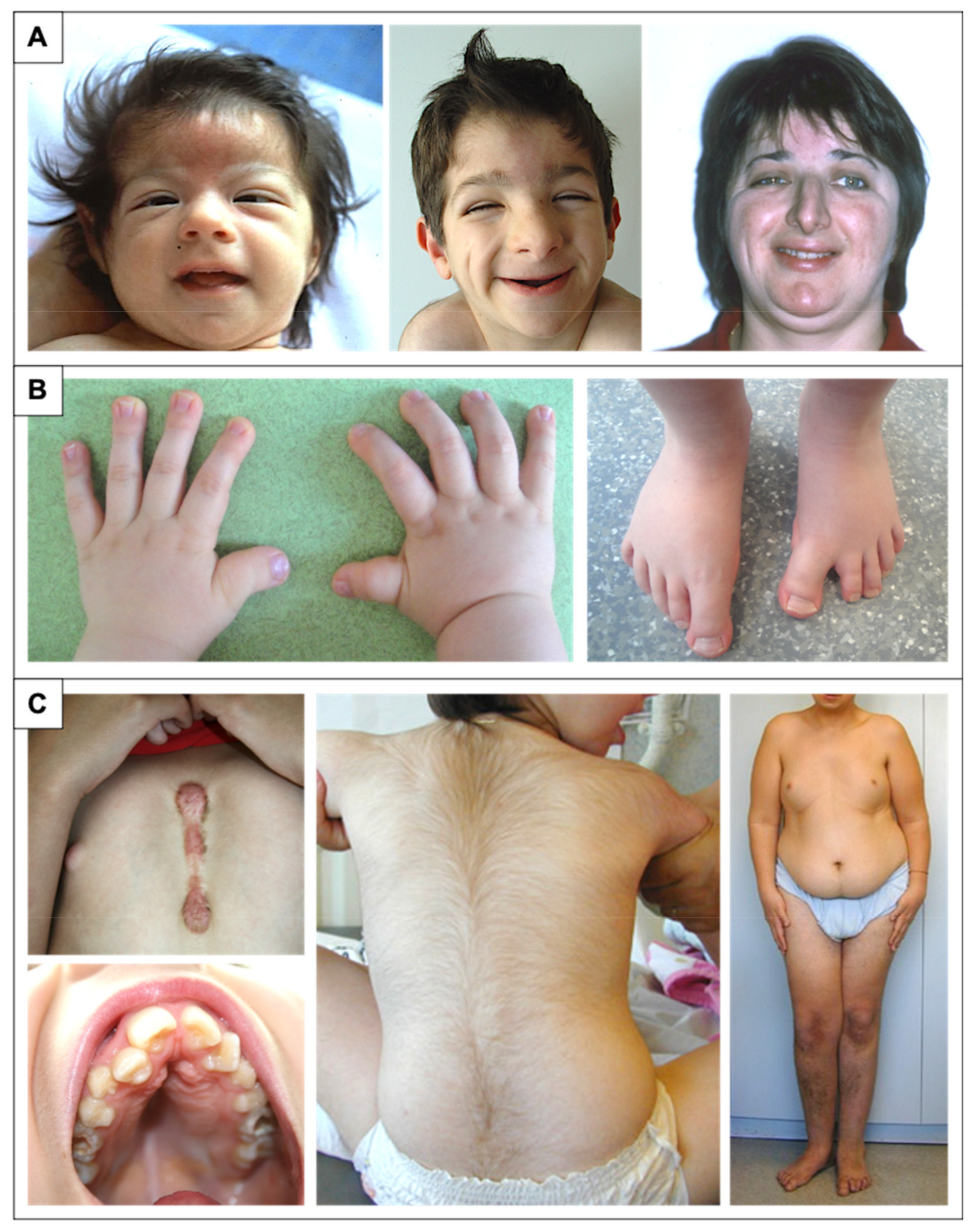 Microdeletions and mutations of CREBBP (CBP) gene can cause