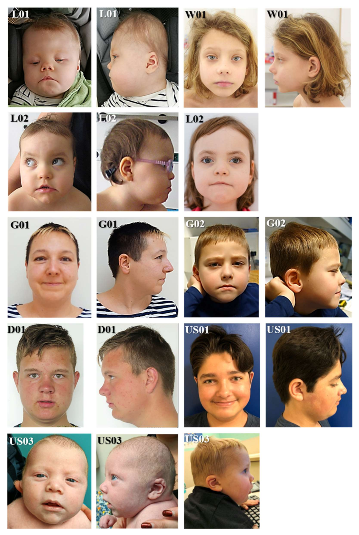 Clinical photos of the patients. (a) Case 1: Dysmorphic facial