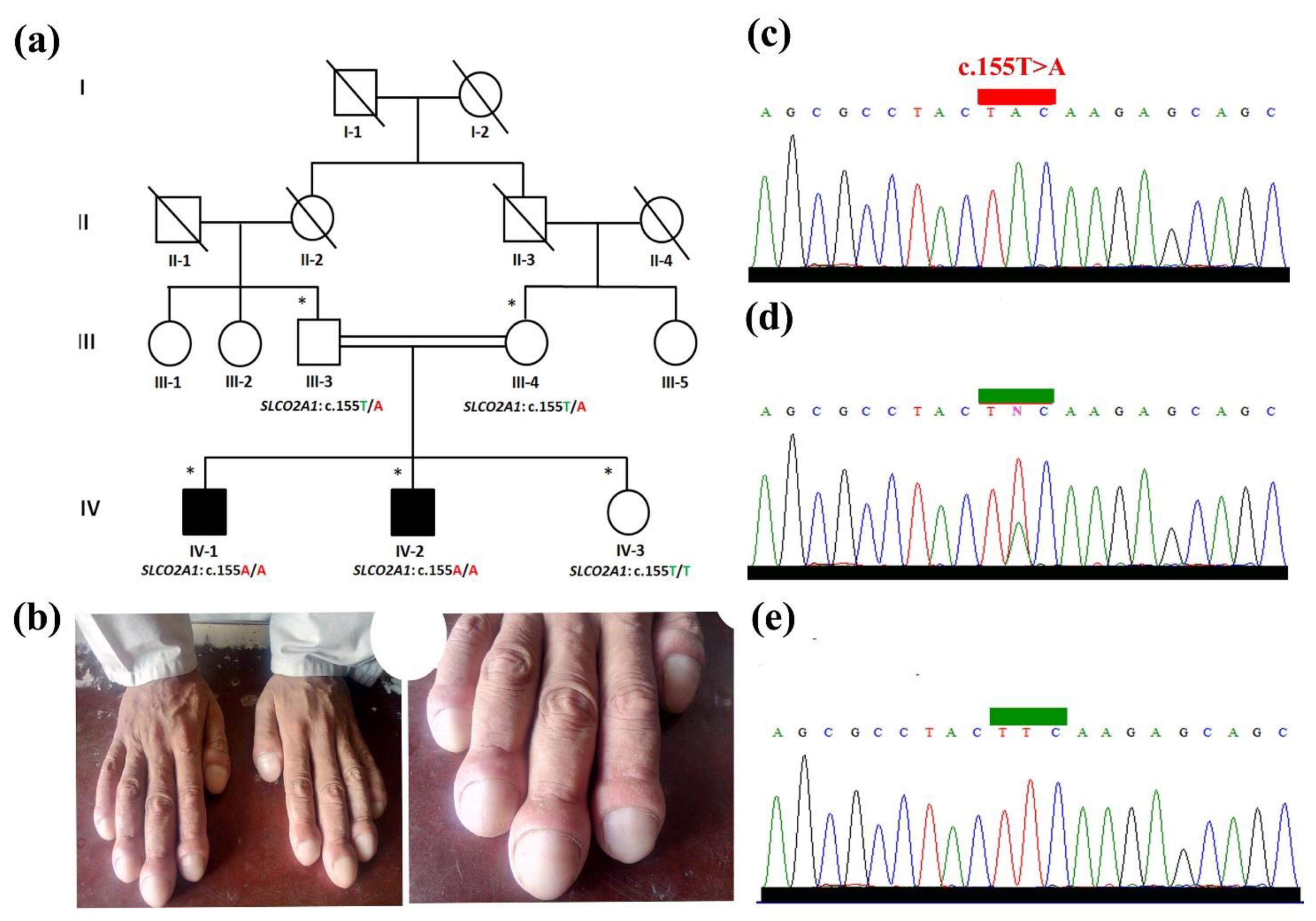 Nonsyndromic congenital nail disorder 10: MedlinePlus Genetics