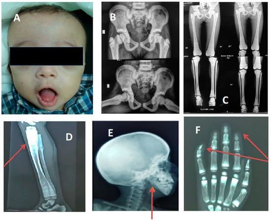 human genetic disorders research paper