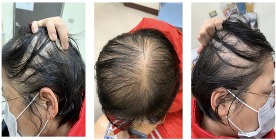 How Does a Female With Pcos Treat Hair Loss or Balding?