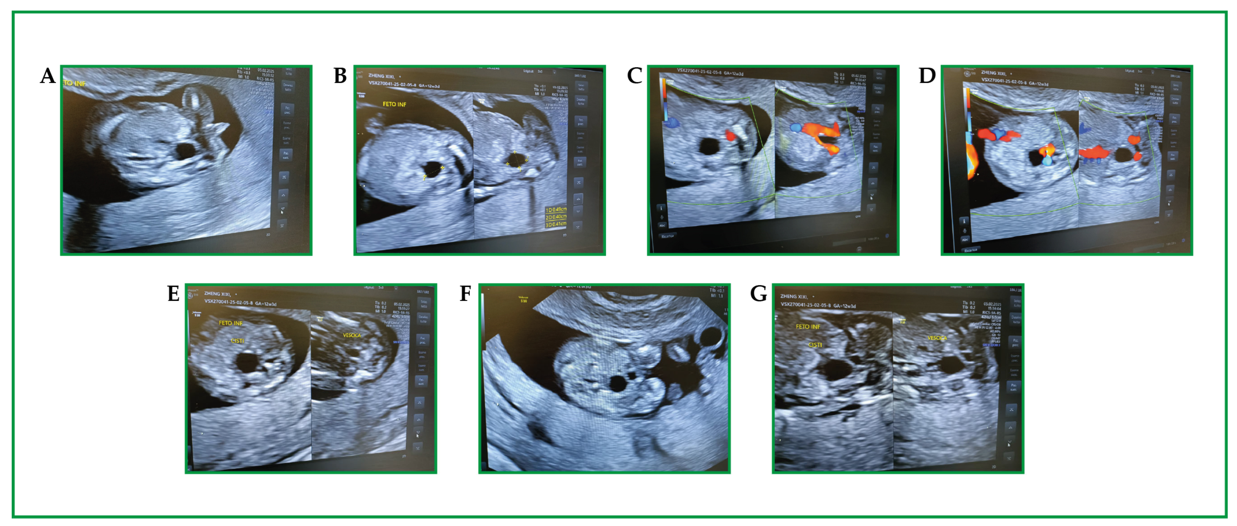 Prenatal Identification of an EDA Variant in Dichorionic Male