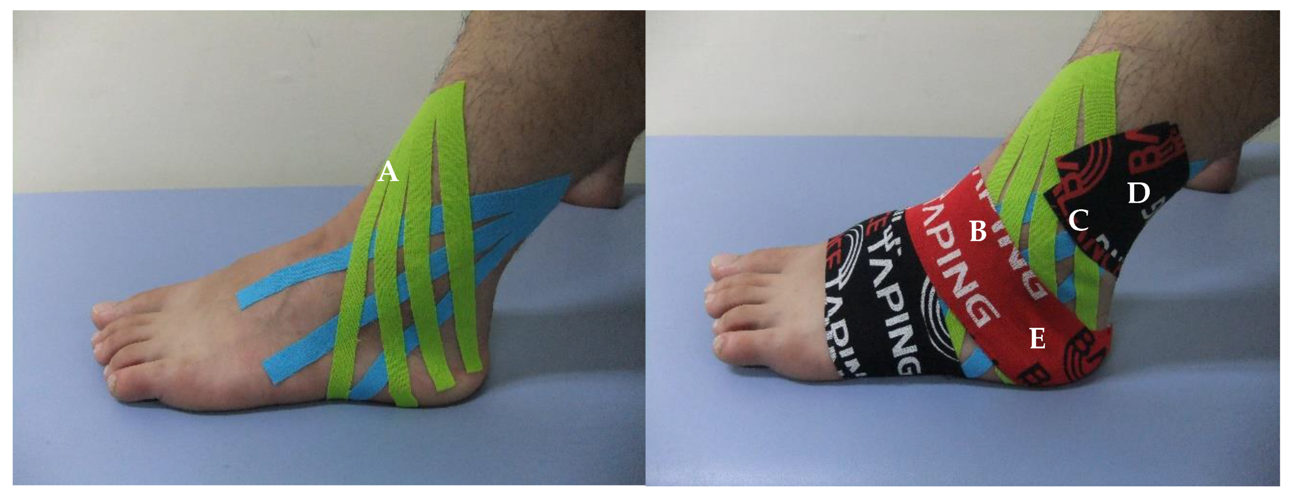Healthcare Free Full-Text Short-Term Effect of Ankle Eversion Taping on Bilateral Acute Ankle Inversion Sprains in an Amateur College Football Goalkeeper A Case Report