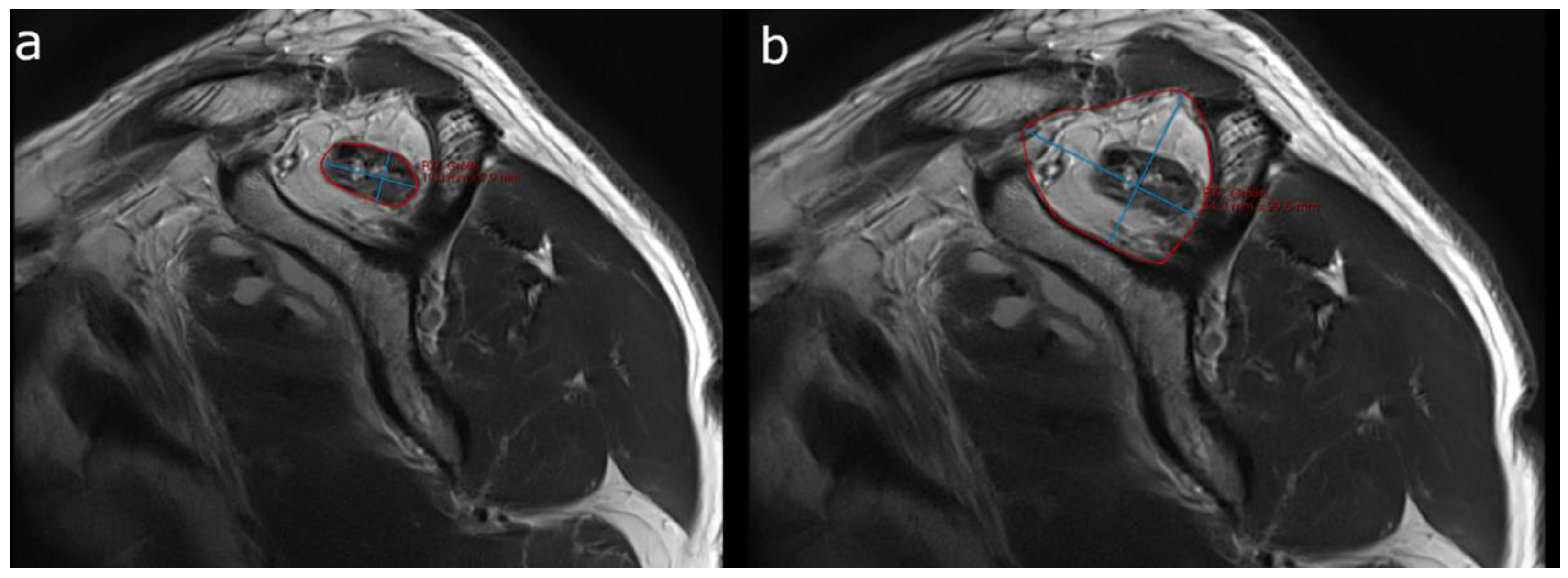 Healthcare Free Full Text Three Dimensional Software And Mr Imaging Based Muscle Volumetry