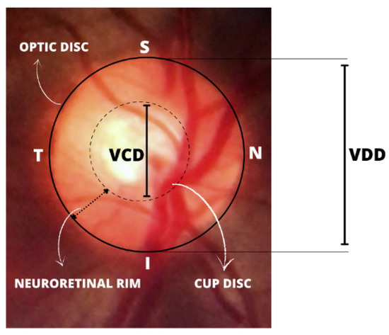 Healthcare | Free Full-Text | Detection Of Glaucoma On Fundus Images ...