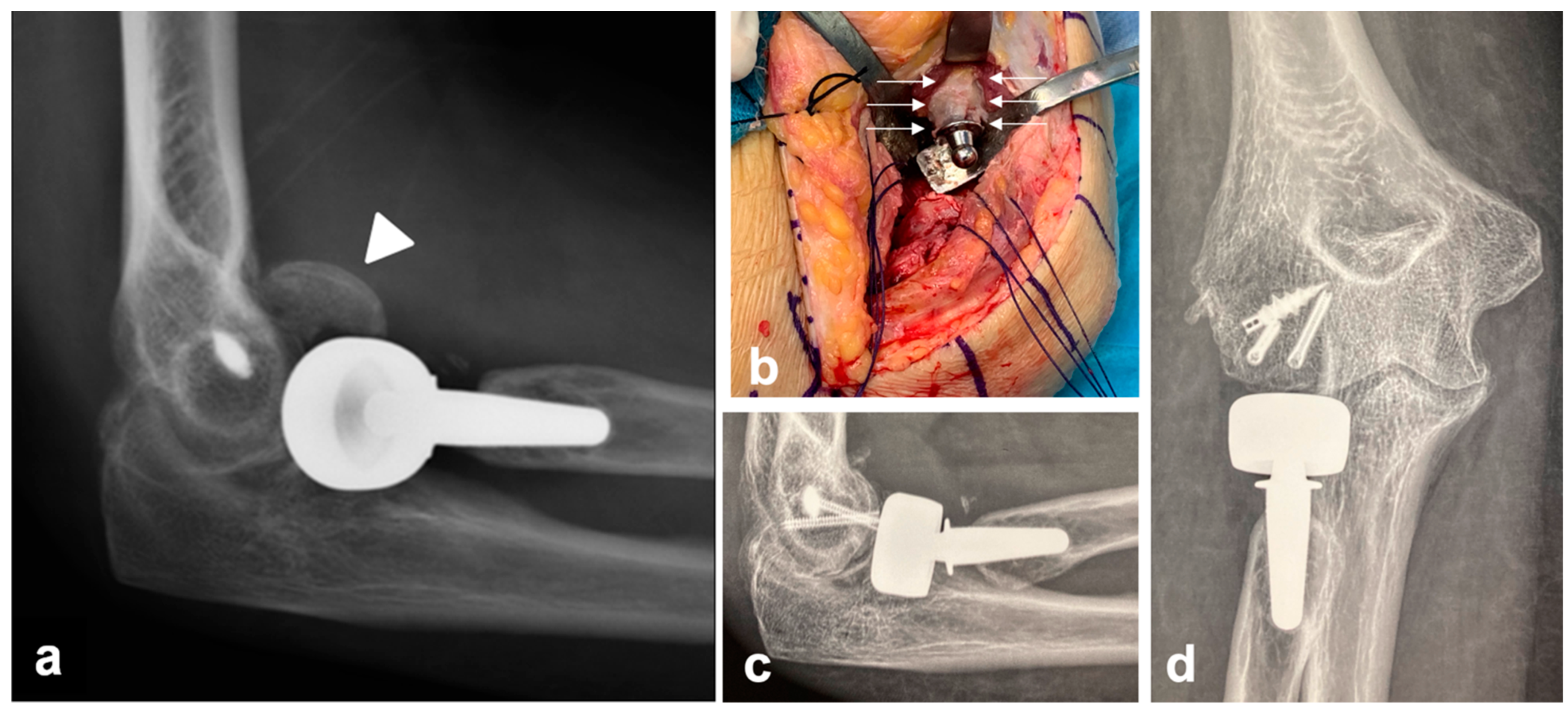 radial head replacement of elbow