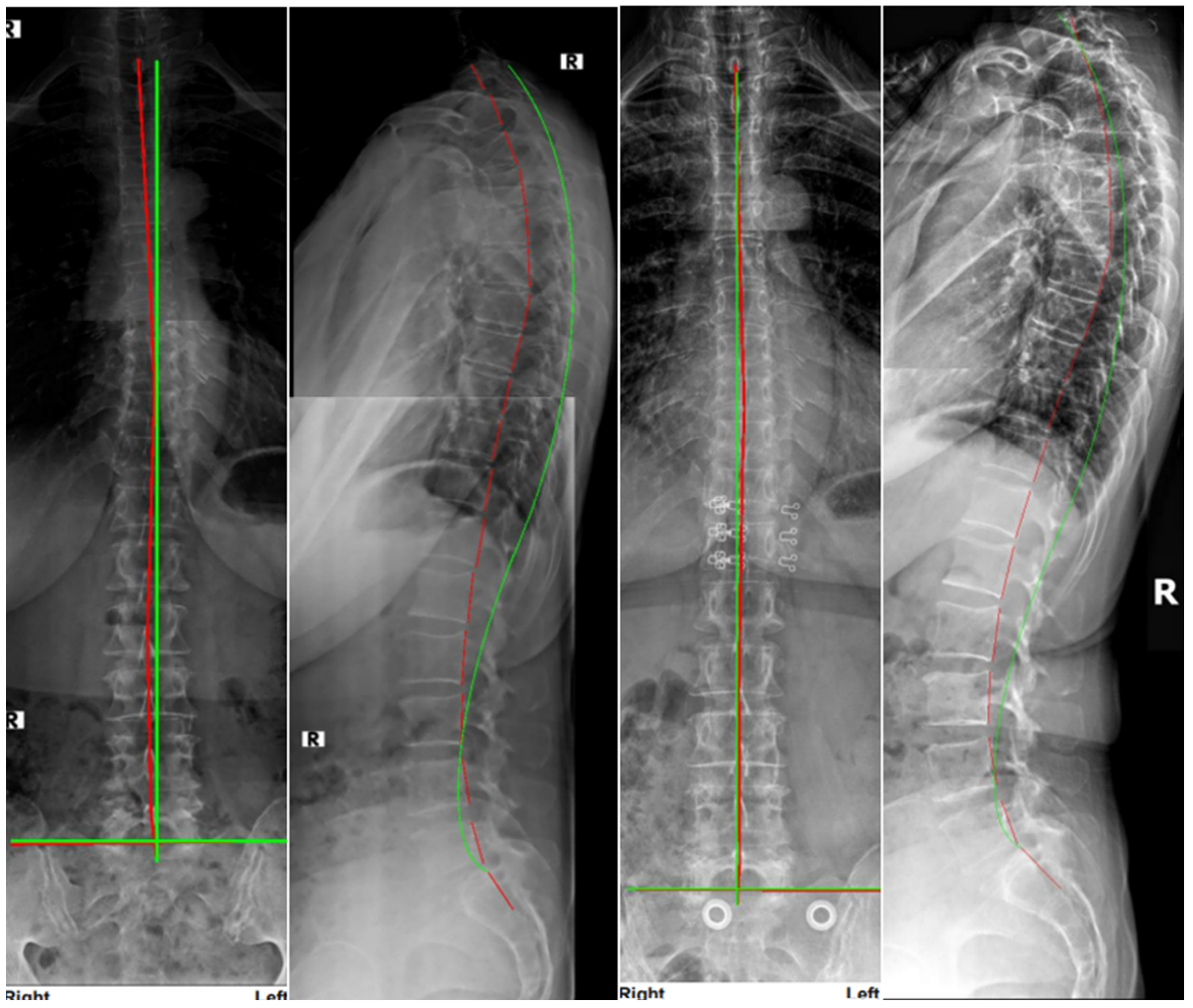 Improved Chronic Low Back Pain, Radiographic Alignment, and Patient ...