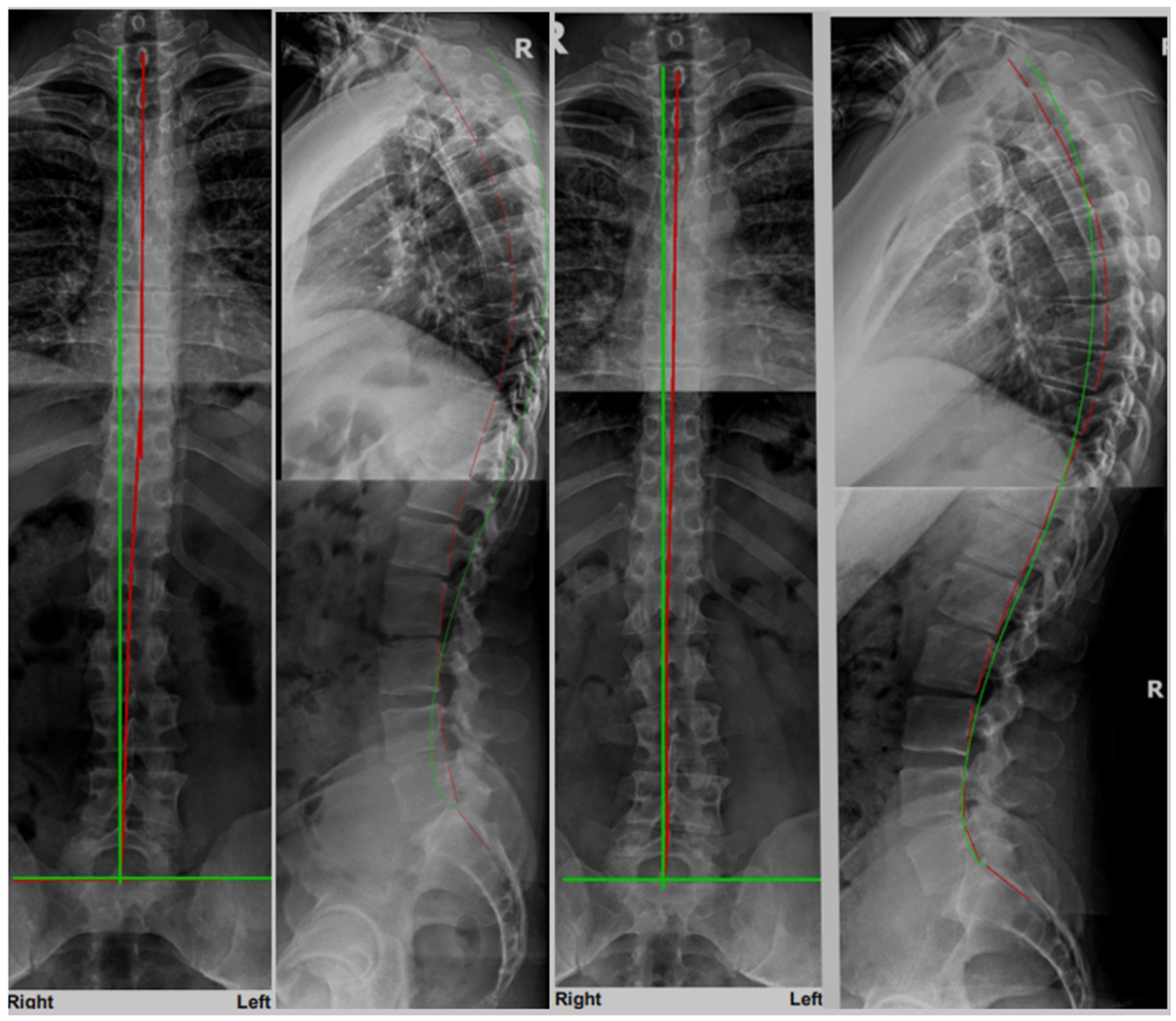 Improved Chronic Low Back Pain, Radiographic Alignment, and Patient ...