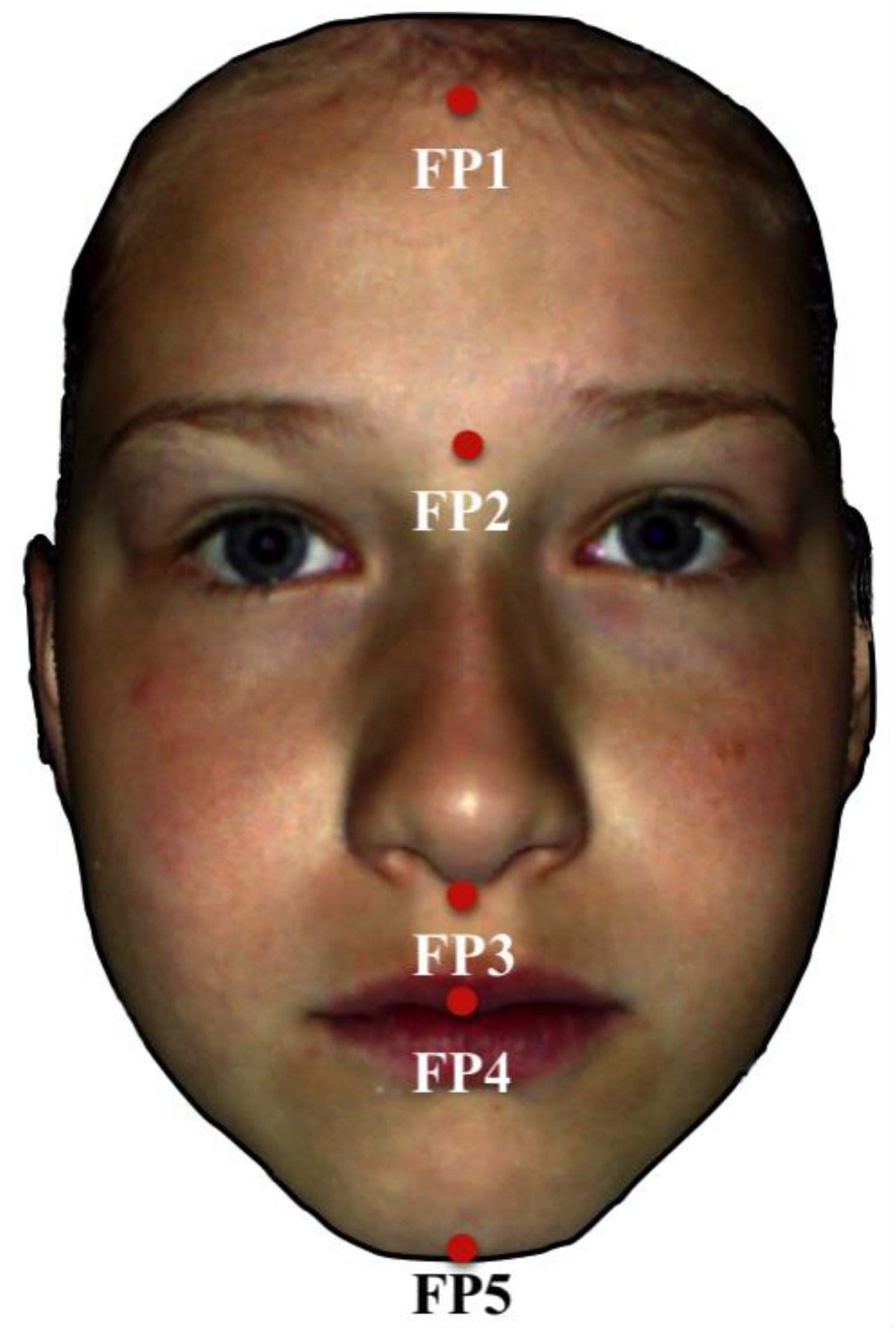fetal alcohol syndrome facial features