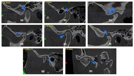 IJERPH | Free Full-Text | Morphology of the Temporomandibular Joints ...