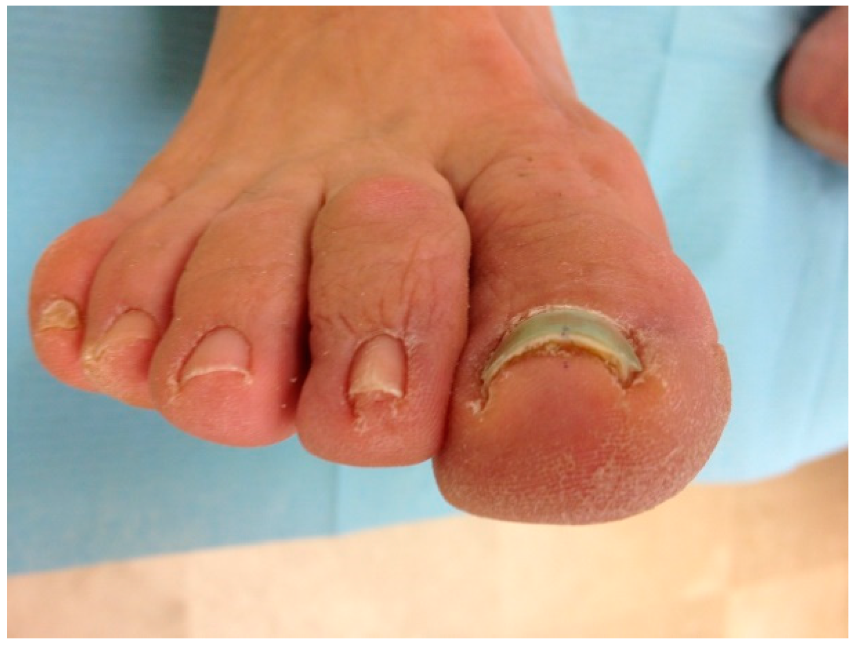 PDF) Pincer nail deformity associated with an arteriovenous fistula for  hemodialysis