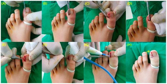 Toenail Disorders During Chemotherapy: Prevention and Care