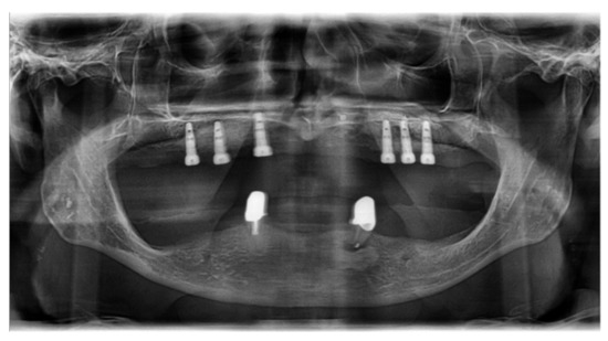 IJERPH | Free Full-Text | Decision-Making in Implantology—A Cross ...