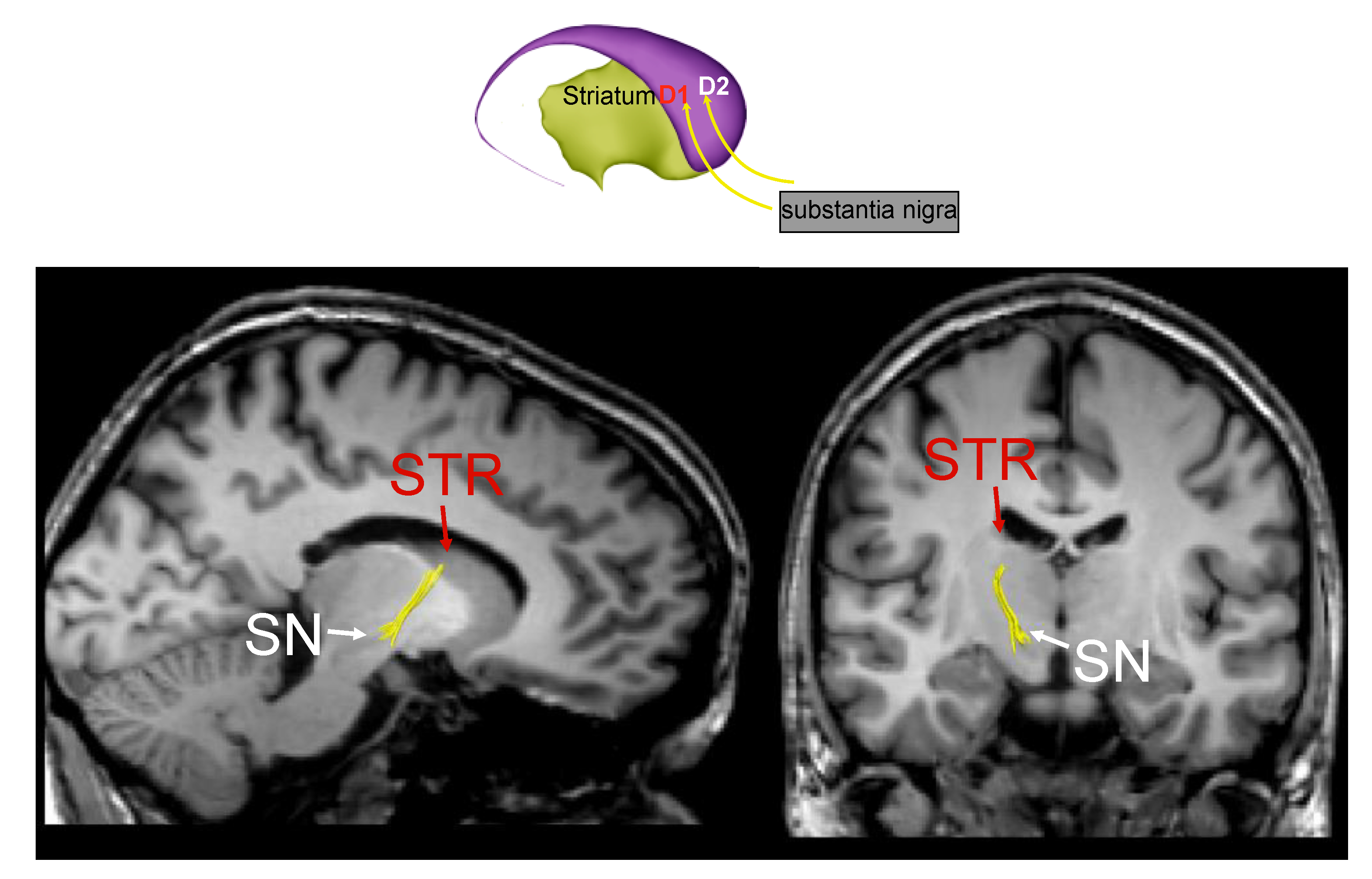Motor Parkinson's disease and structure (Chapter 3) - Magnetic Resonance  Imaging in Movement Disorders