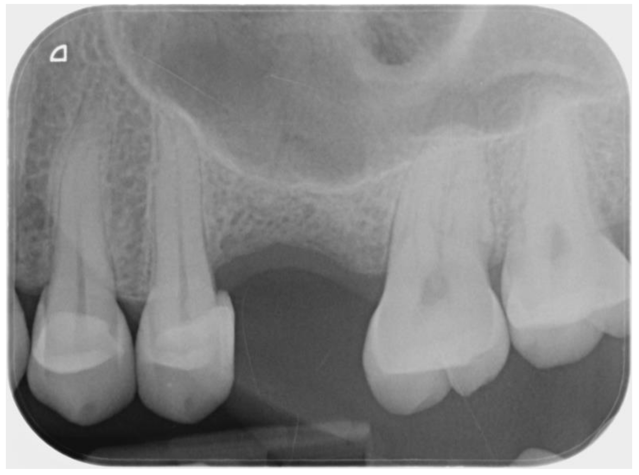 Elevation an d d ecreasing water F level vs. dental caries in seven