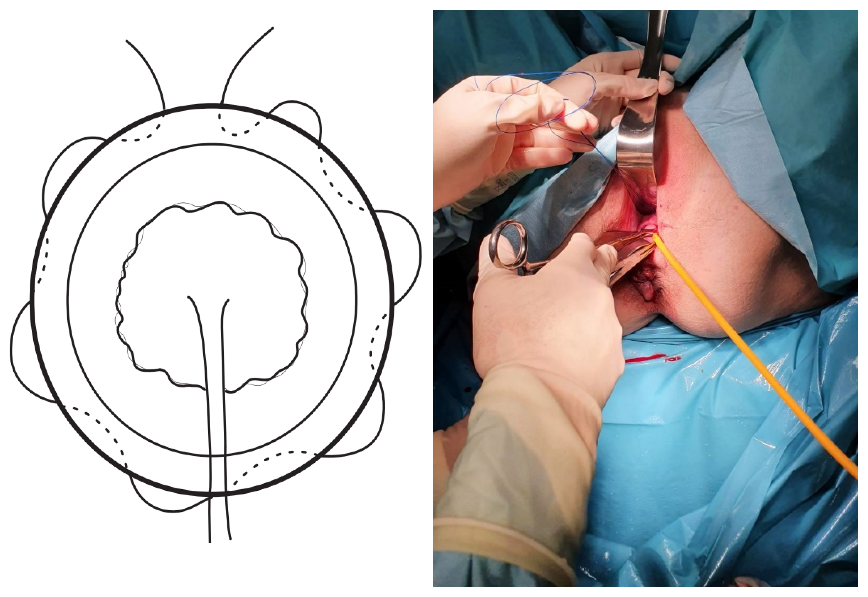 Official Title of the Study: Suturing with U-Technique versus Un-  Reapproximated wound Edges during removal of Closed Thoracosto