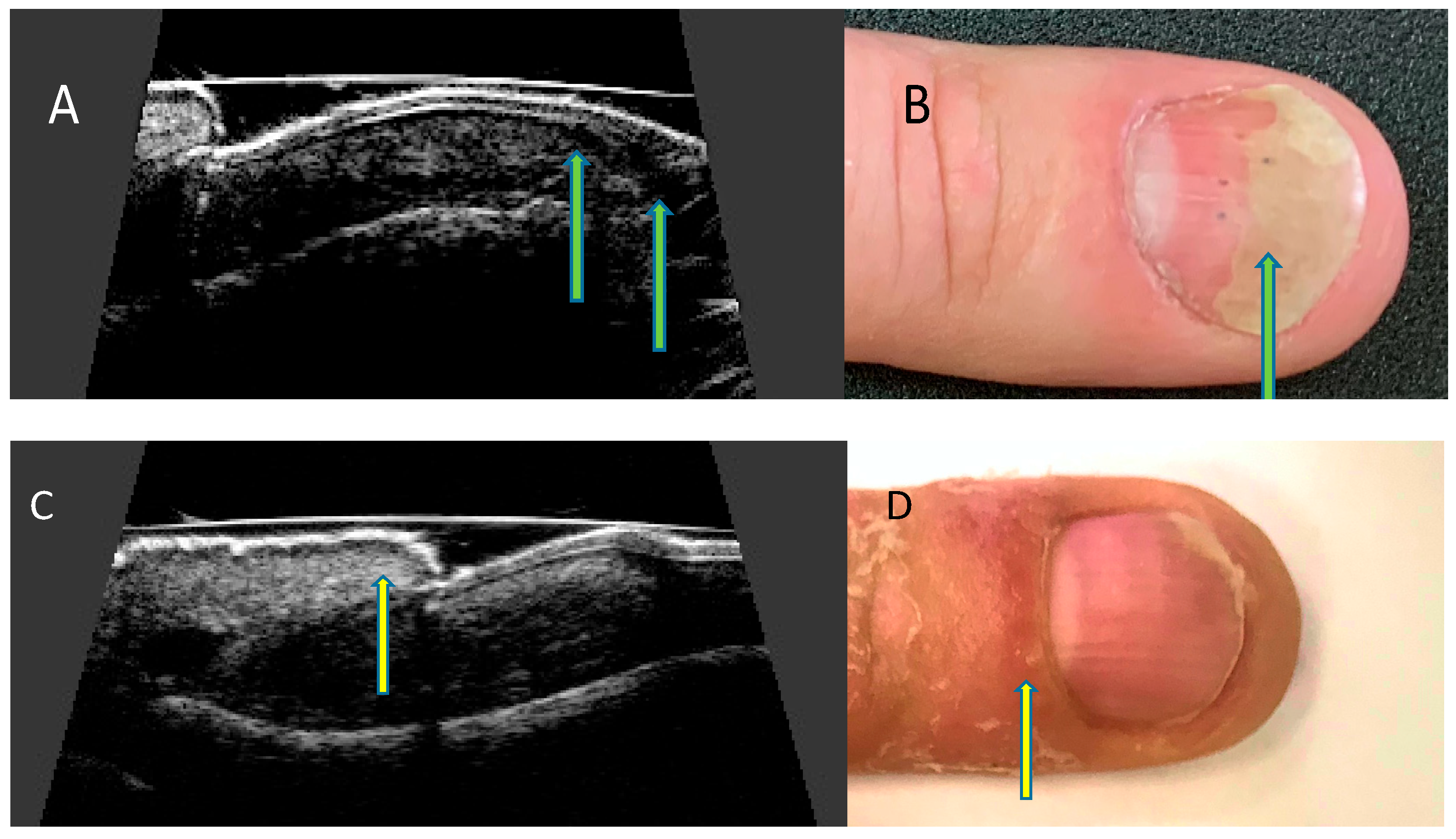 Nails in systemic disease | RCP Journals
