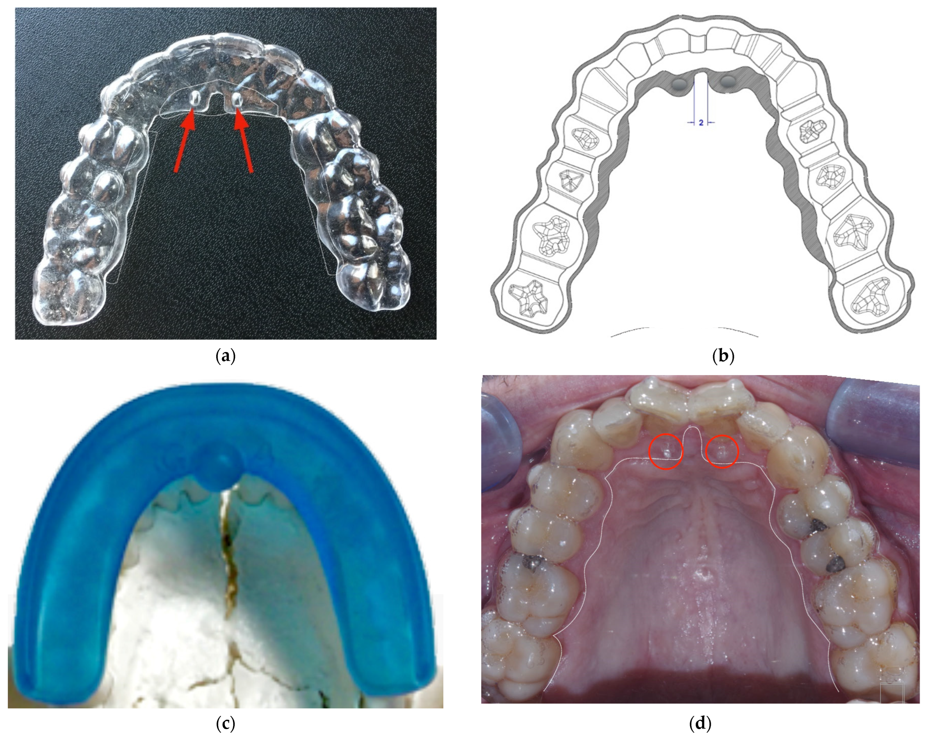 History, Present and Future of Aligners