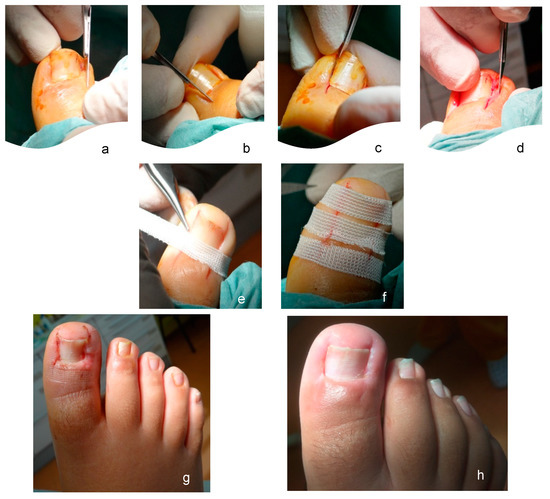 Does Ingrown Toenail Surgery Hurt? - Southern California Foot & Ankle  Specialists