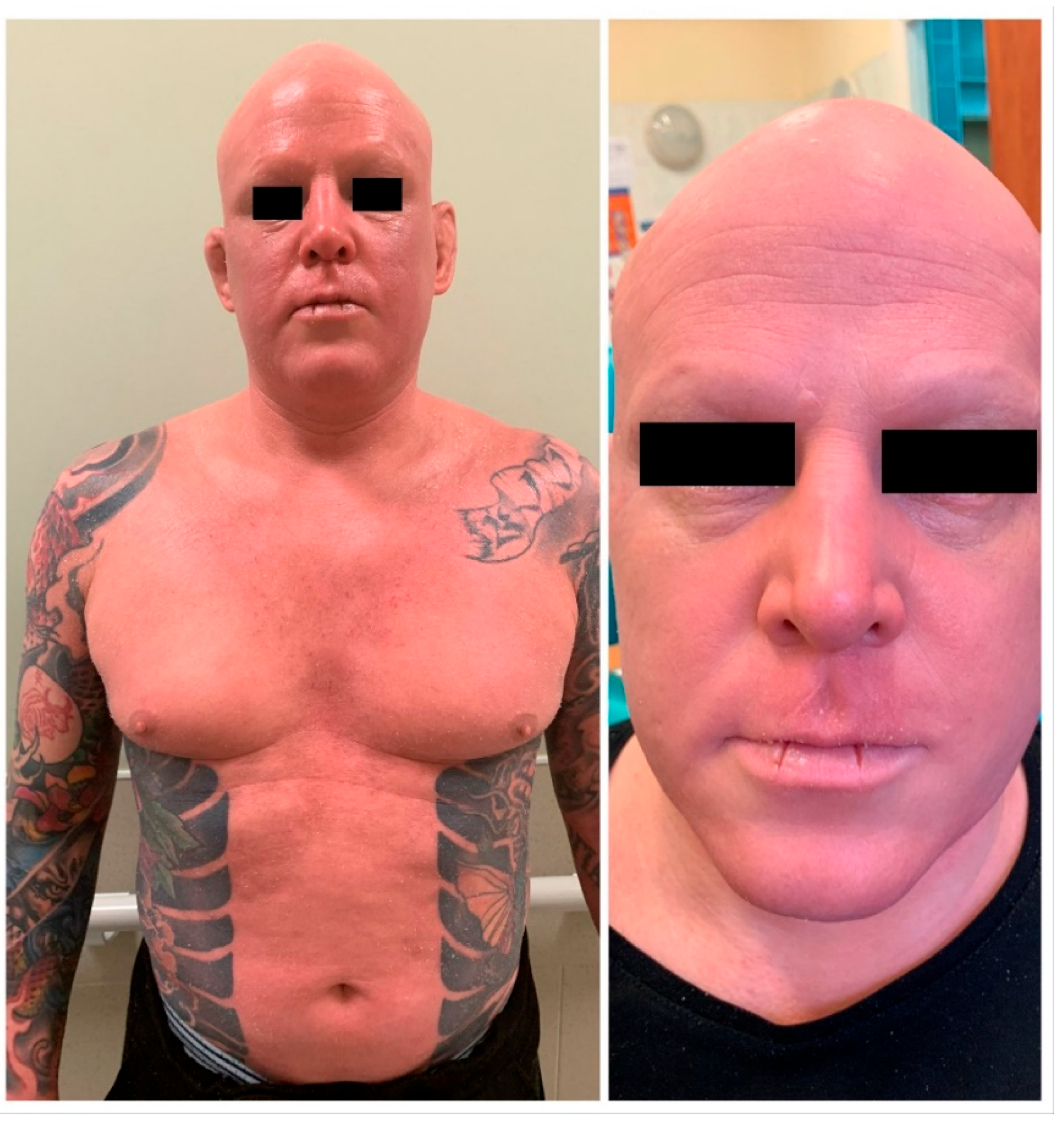 IJERPH | Free Full-Text | When Body Art Goes Awry—Severe Systemic  Allergic Reaction to Red Ink Tattoo Requiring Surgical Treatment