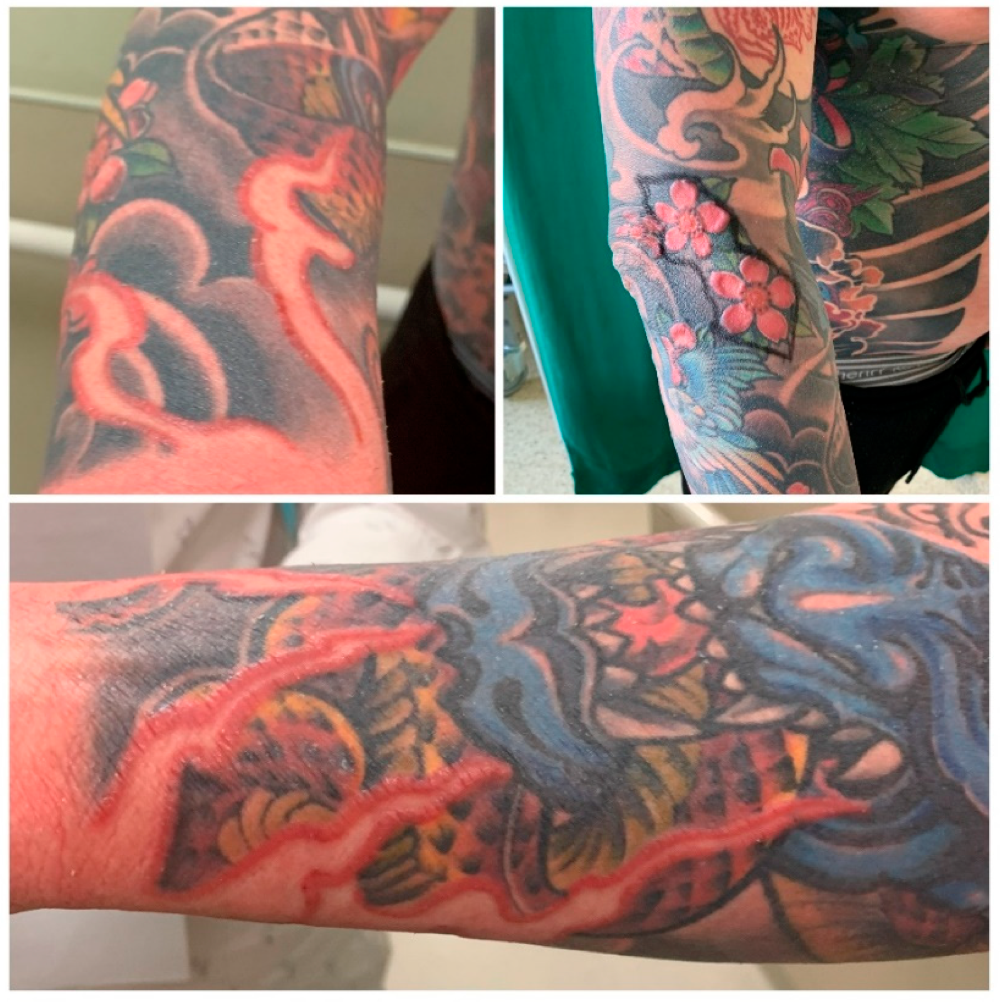 Inflammation occurring in the red ink portion of a tattoo. Reaction to