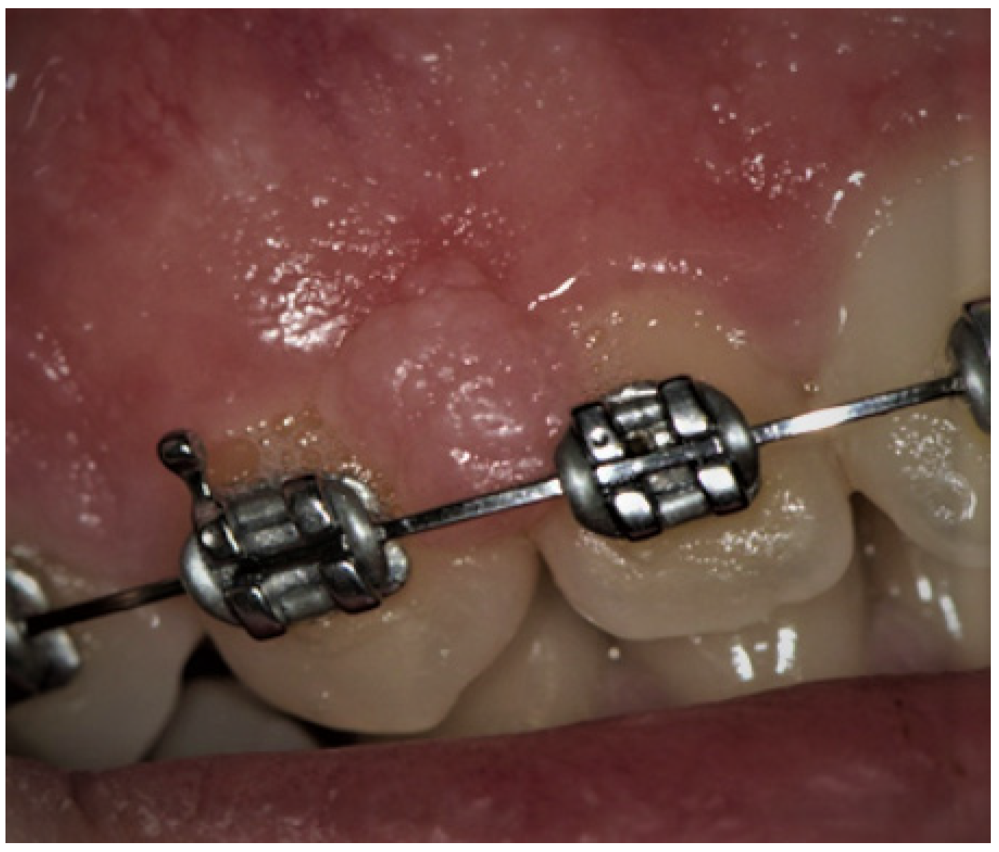 Columbia PA Orthodontist, Elastics For Braces