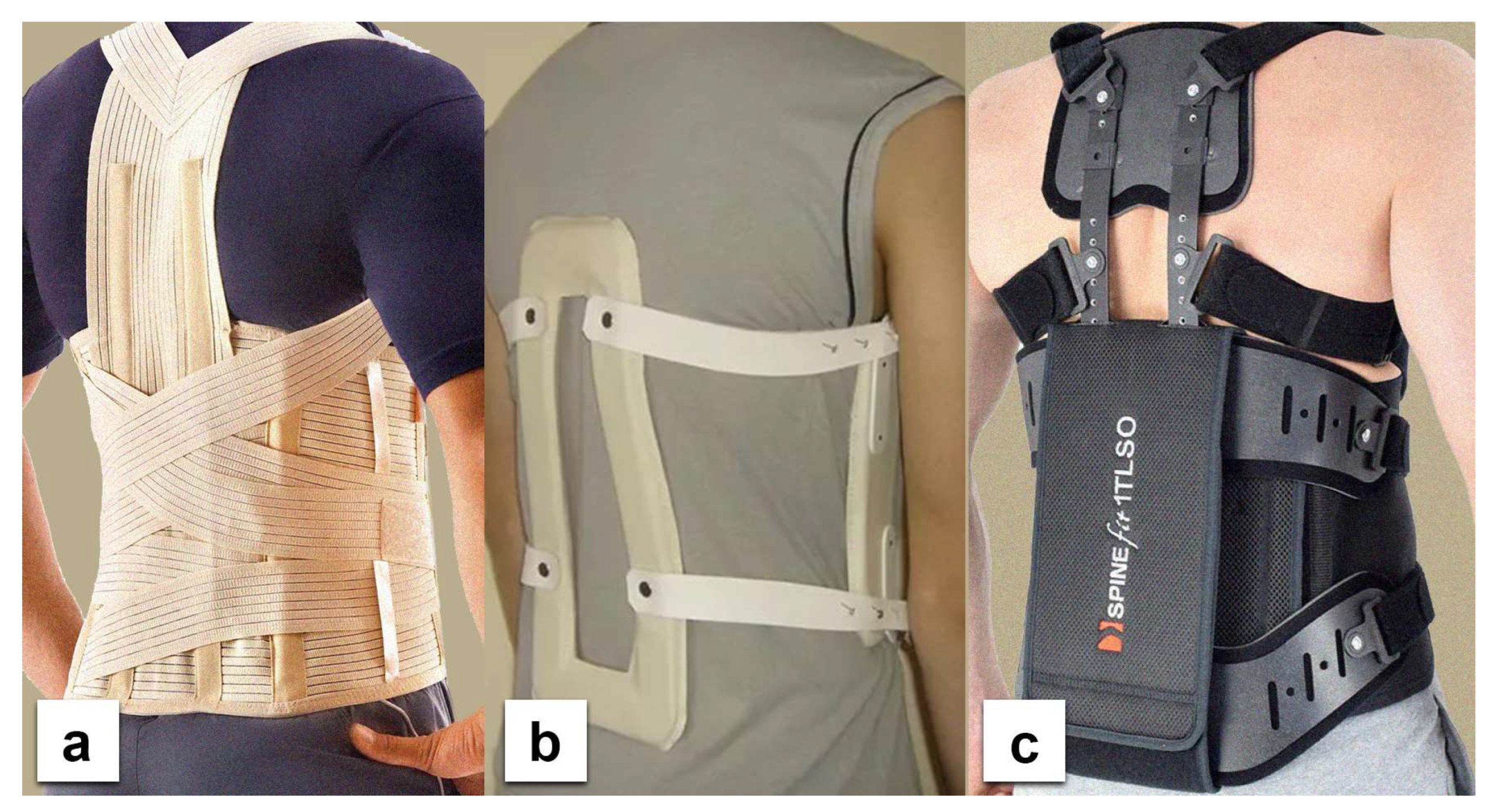 PDF] Early mobilization with customized TLSO brace in