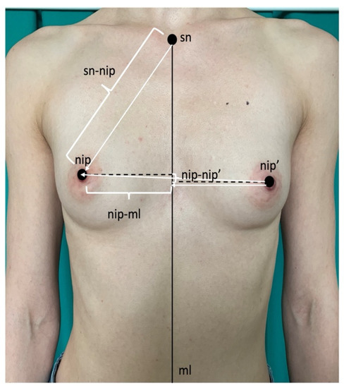 a) Absent breast development pre-steroid initiation, (b) Breast