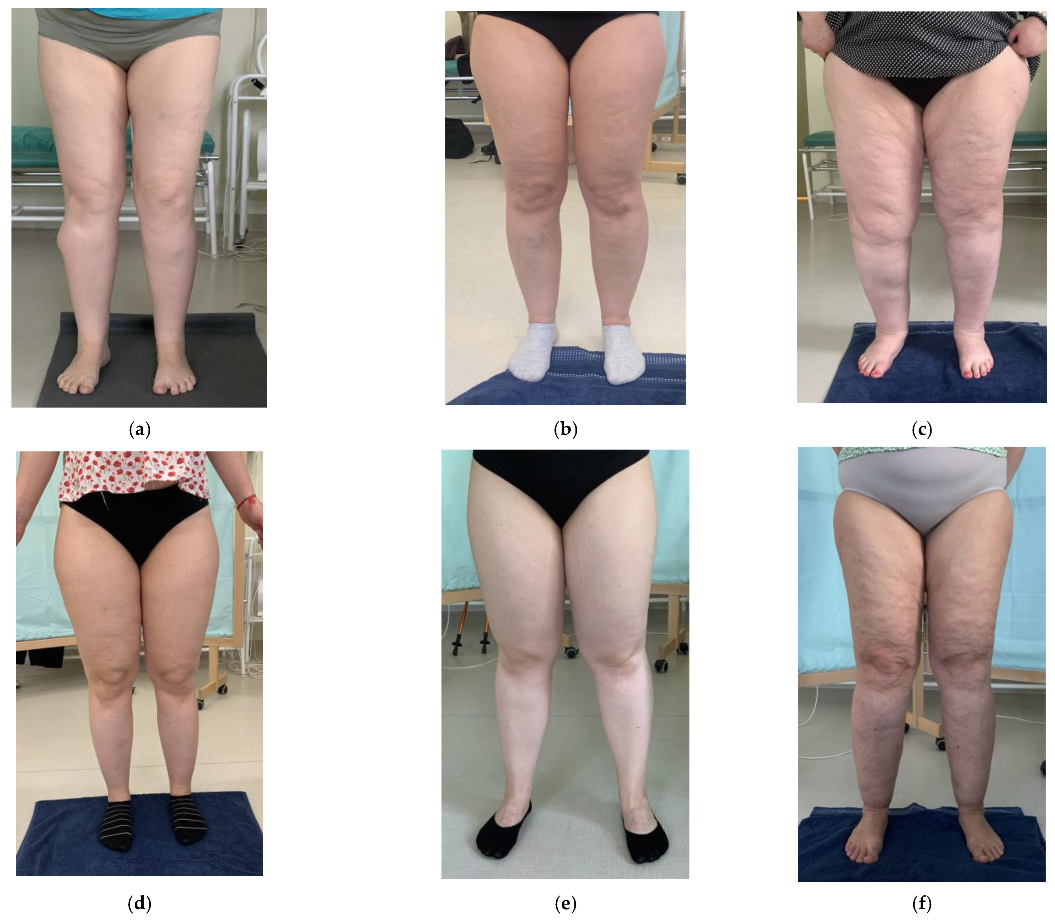 ARE FAT LEGS AT PUBERTY AN EARLY SIGN OF LIPEDEMA? - Total