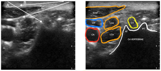 PDF) Comparison of the spread of injectate after ultrasound-guided