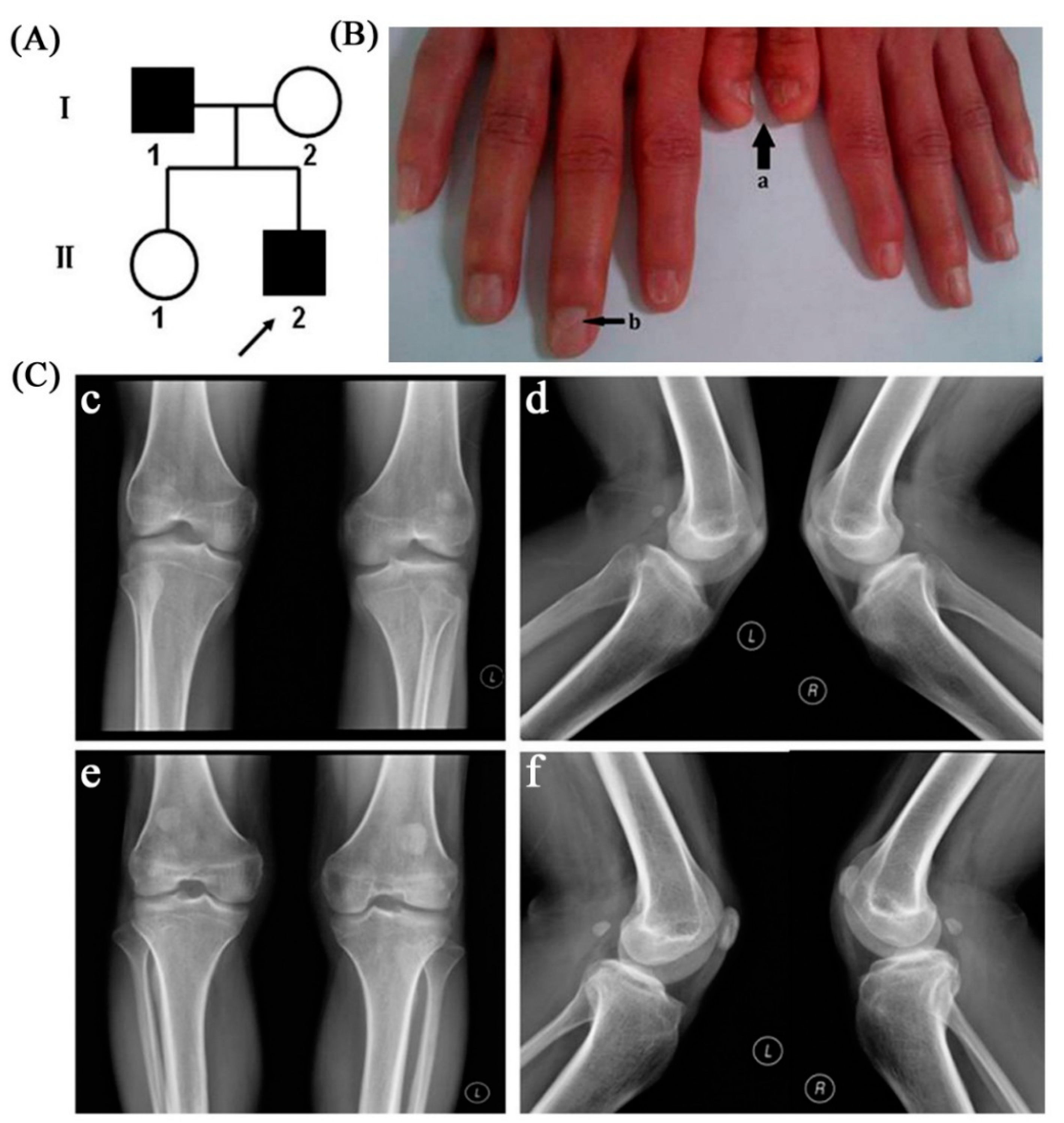 Nail‑Patella syndrome with early onset end‑stage renal disease in a child  with a novel heterozygous missense mutation in the LMX1B homeodomain: A  case report