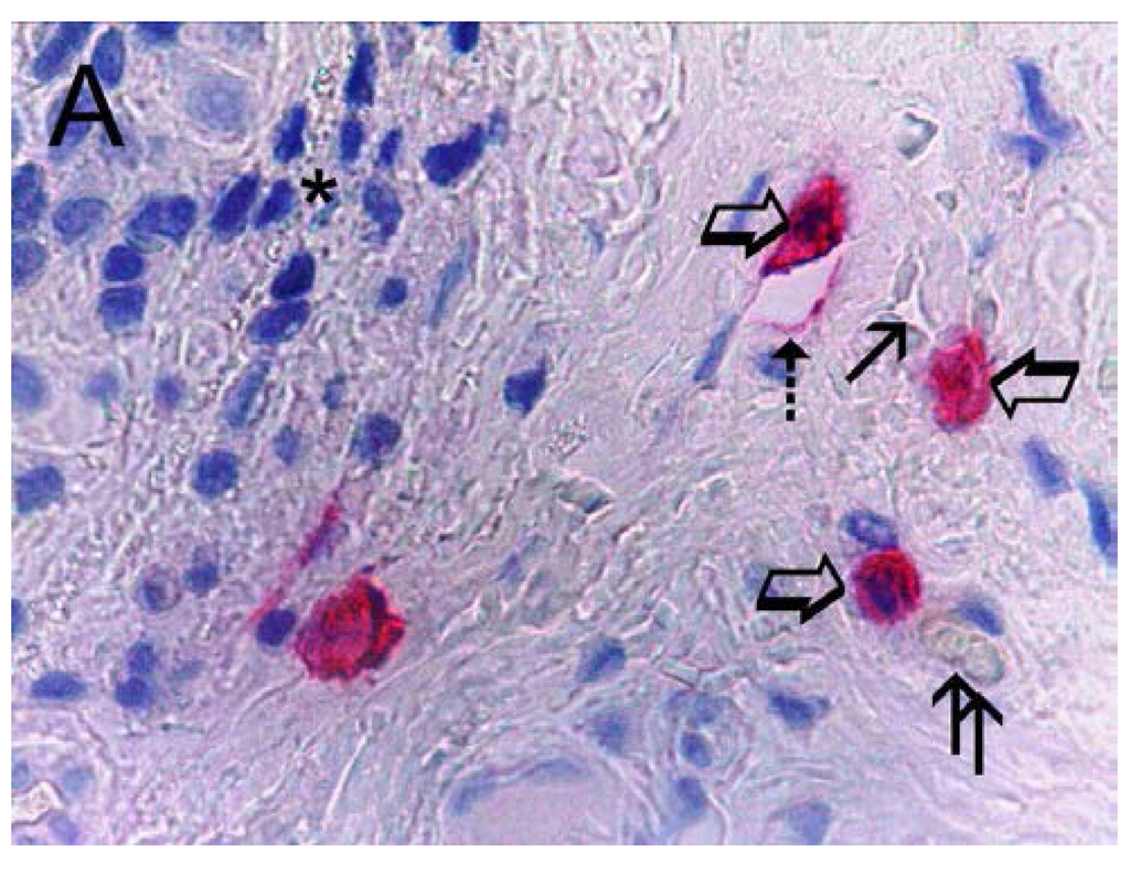 IJMS | Free Full-Text | Infiltrating Mast Cells Correlate With ...