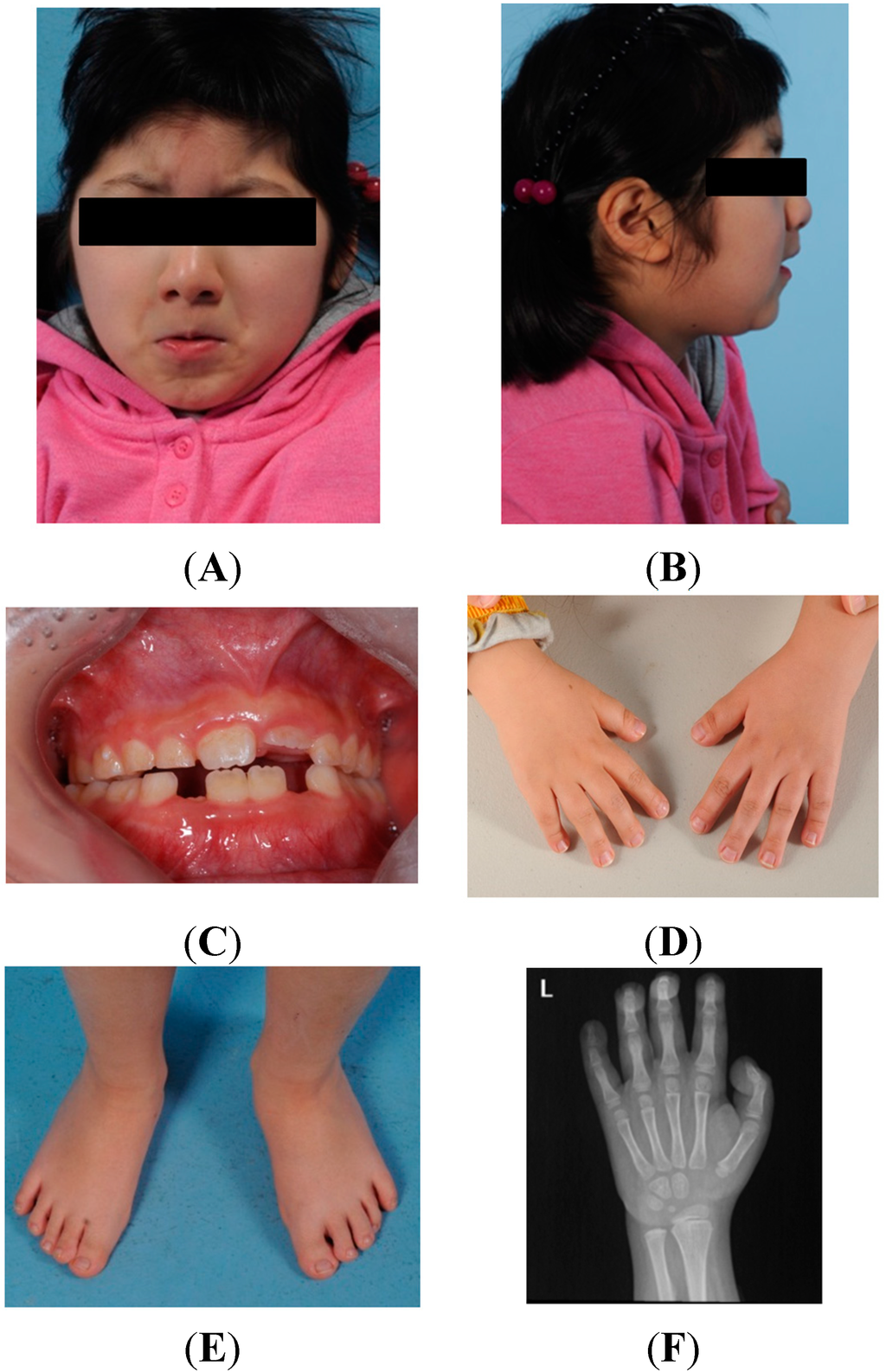 Anaesthesia Management in a Child with Rubinstein - Taybi Syndrome