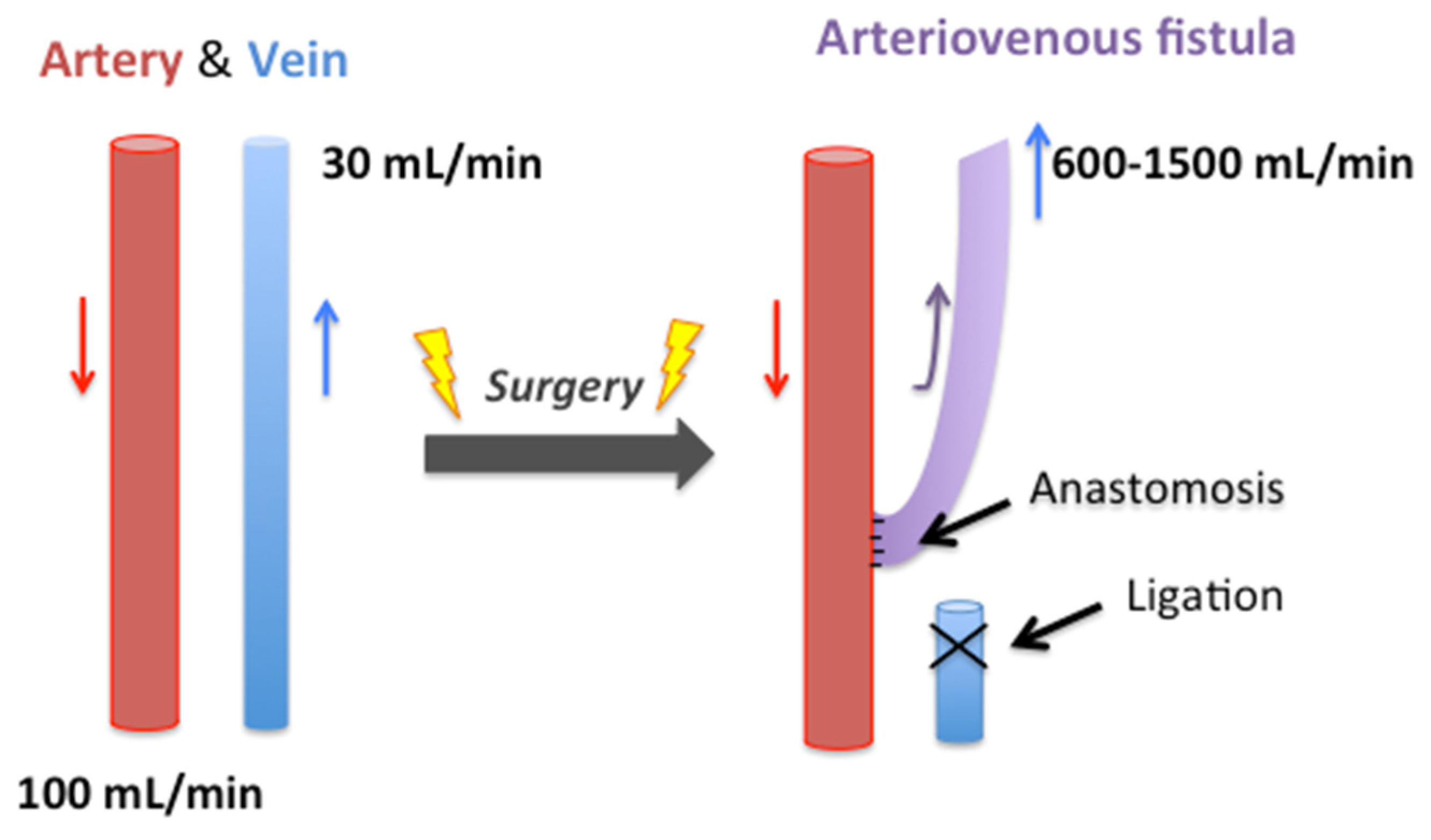 Far infrared therapy for arteriovenous fistulas
