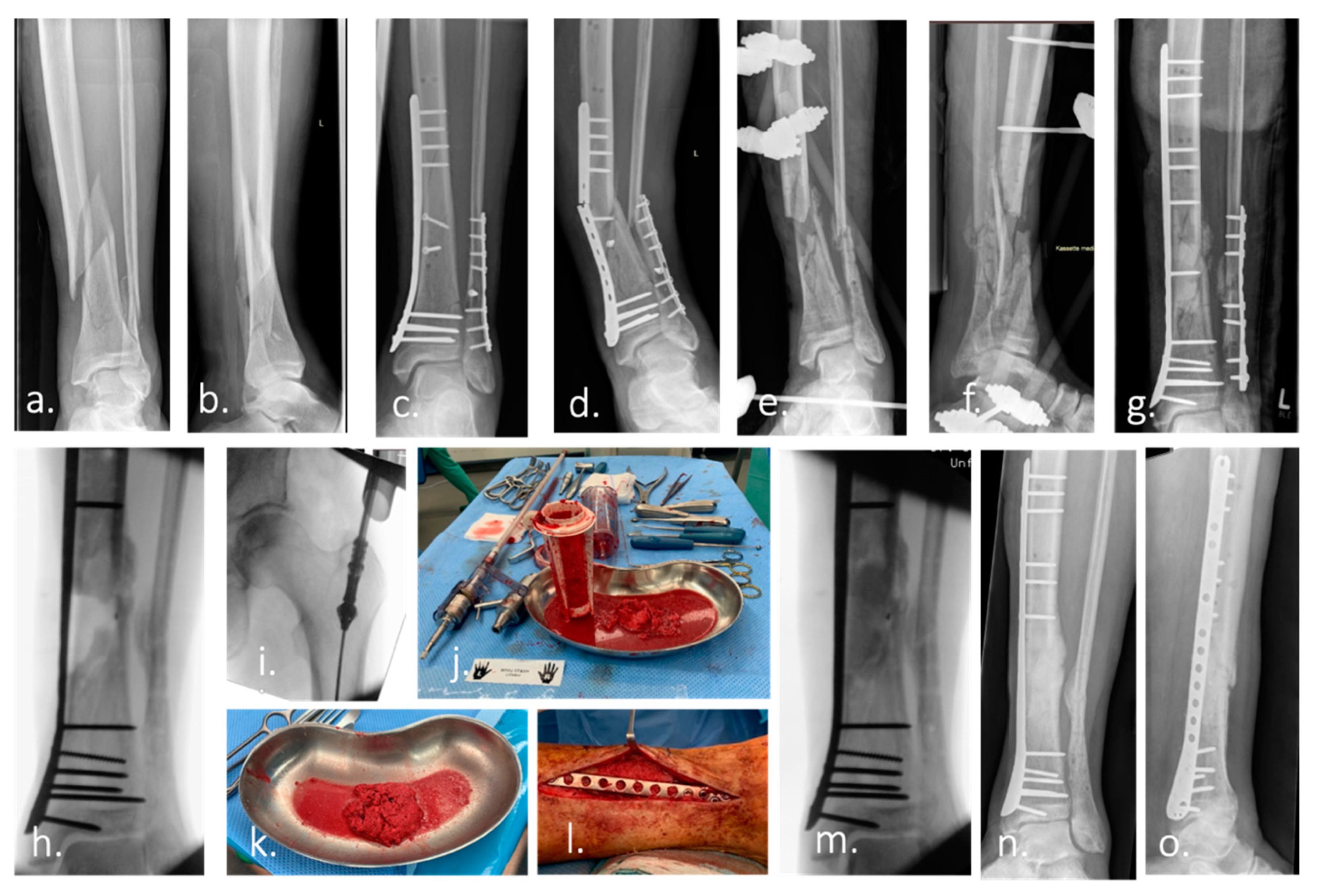 Malunited fracture - tibia, Radiology Case