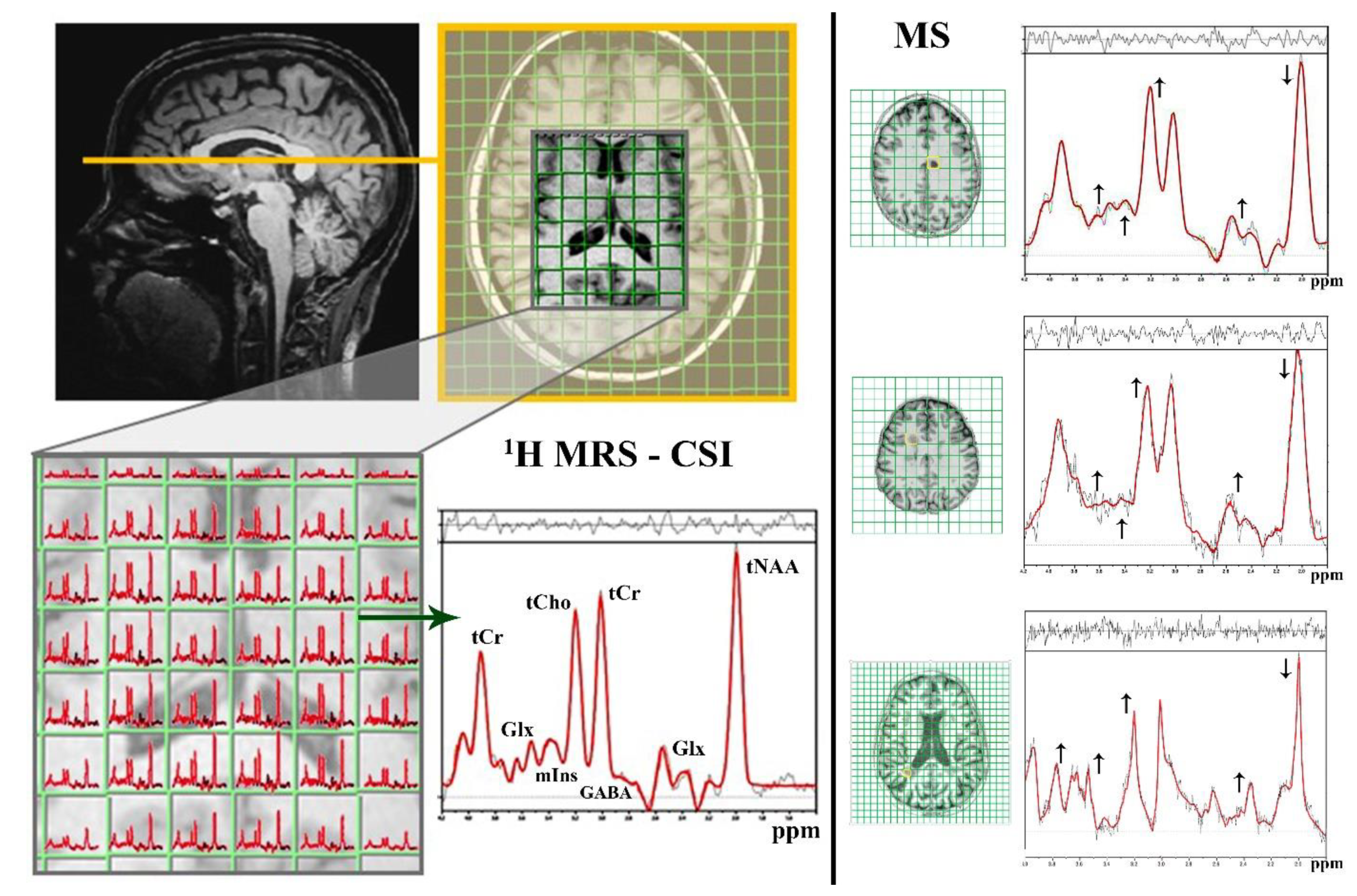| Free Full-Text | Current Methods of Magnetic Resonance for Noninvasive Assessment of Molecular of Pathoetiology in Multiple Sclerosis