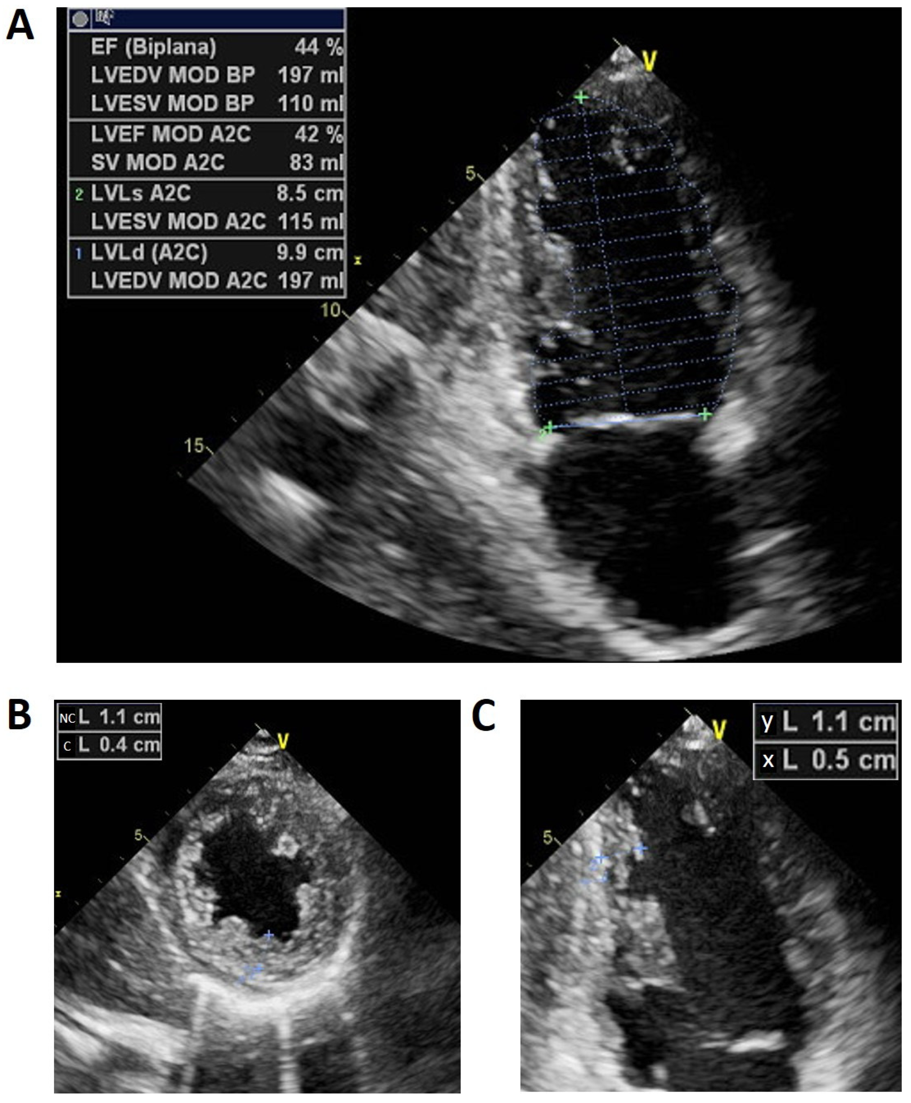 Basic Echocardiography in Dilated Cardiomyopathy
