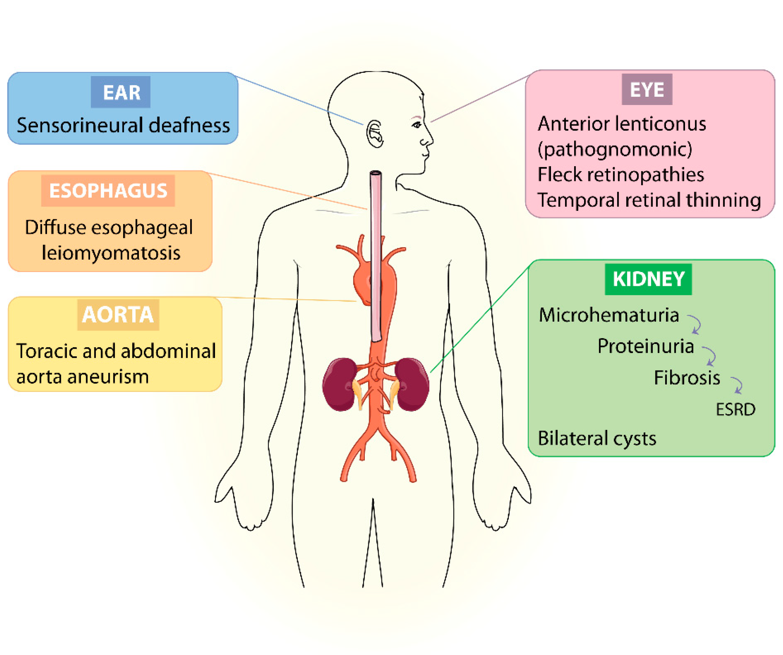 renal biopsy alport syndrome