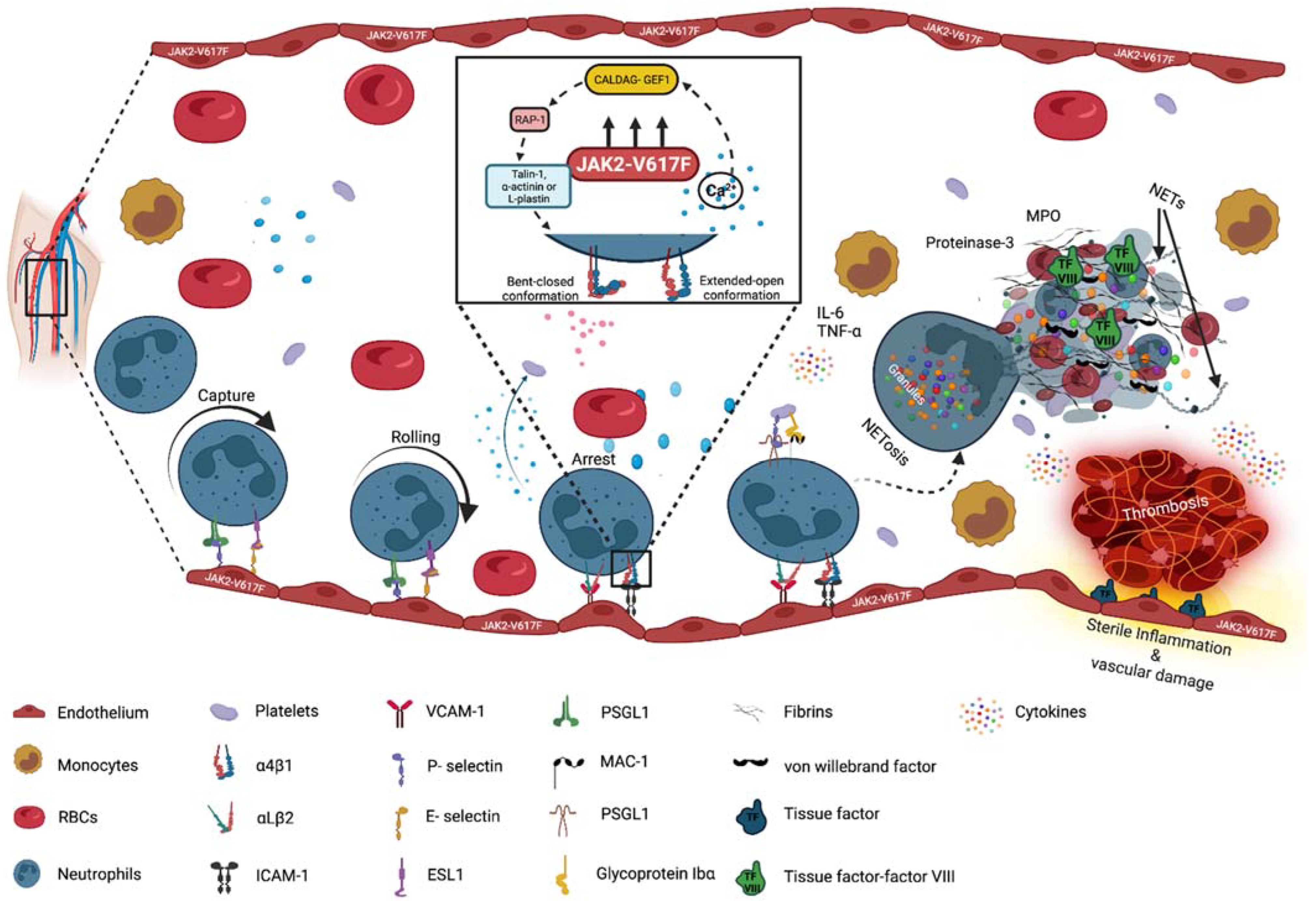 The myeloproliferative blood cancers—essential thrombocytosis (ET