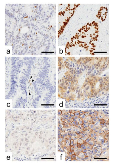 The Complete Loss of p53 Expression Uniquely Predicts Worse Prognosis ...