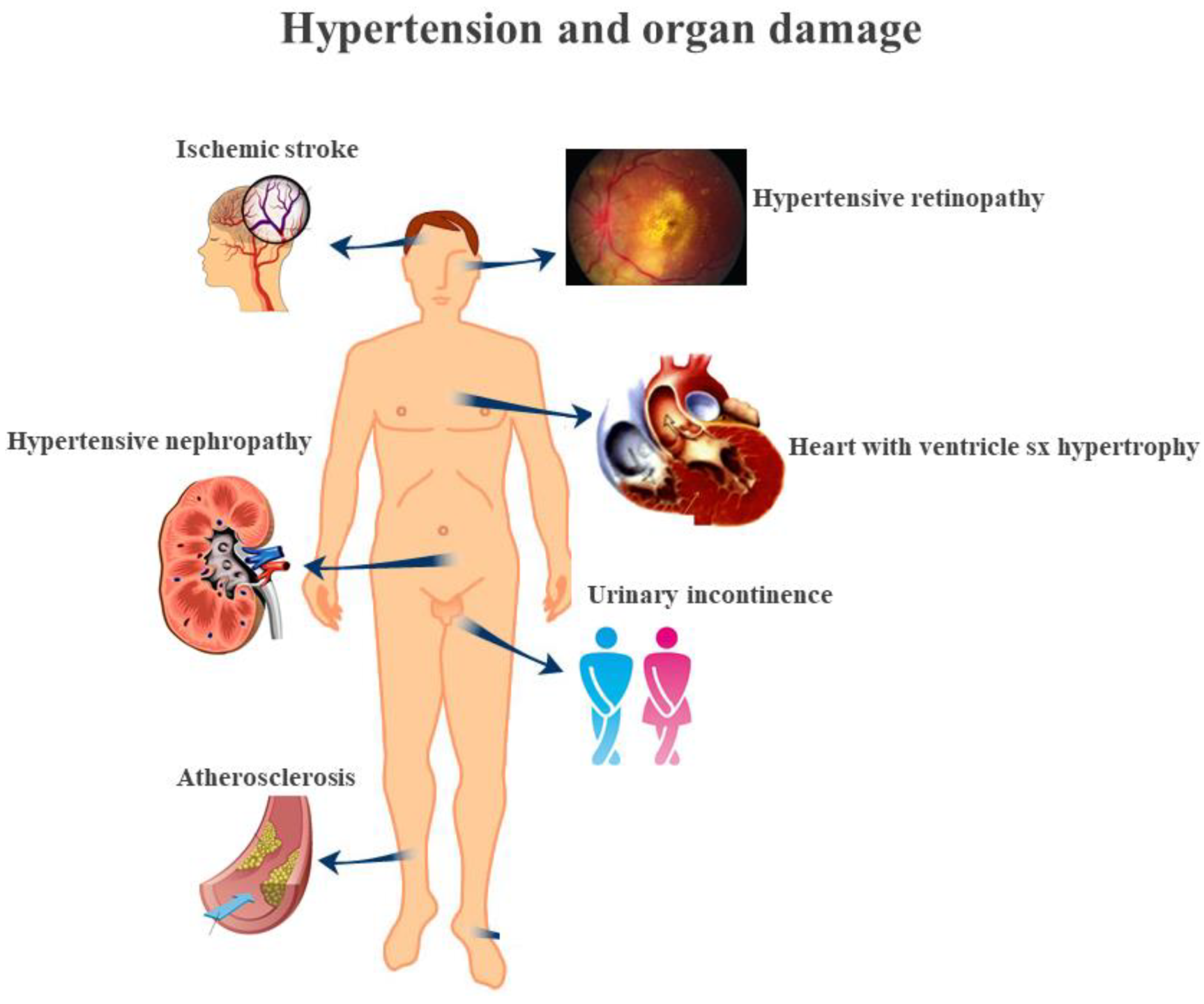 IJMS Free Full-Text The Contribution of Gut Microbiota and Endothelial Dysfunction in the Development of Arterial Hypertension in Animal Models and in Humans
